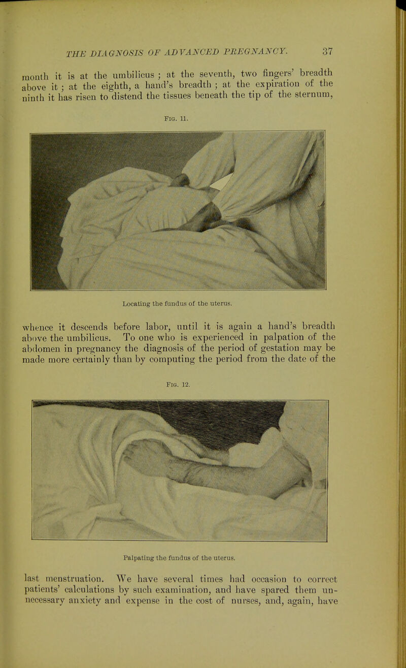 month it is at the umbilicus ; at the seventh, two fingers' breadth above it ; at the eighth, a hand's breadth ; at the expiration of the ninth it has risen to distend the tissues beneath the tip of the sternum, Fig. 11. Locating the fundus of the uterus. whence it descends before labor, until it is again a hand's breadth above the umbilicus. To one who is experienced in palpation of the abdomen in pregnancy the diagnosis of the period of gestation may be made more certainly than by computing the period from the date of the Fig. 12. i Palpating the fundus of the uterus. la.st menstruation. We have several times had occasion to correct patients' calculations by such examination, and have spared them un- necessary anxiety and expense in the cost of nurses, and, again, have