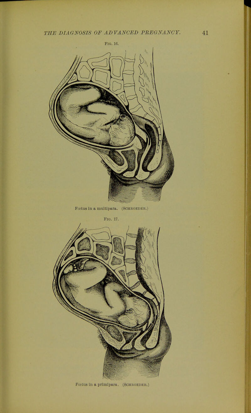 Fig. 16. Fcetus in a multipara. (Schroeder.) Fig. 17. Foetus in a primipara. (Schroeder.)