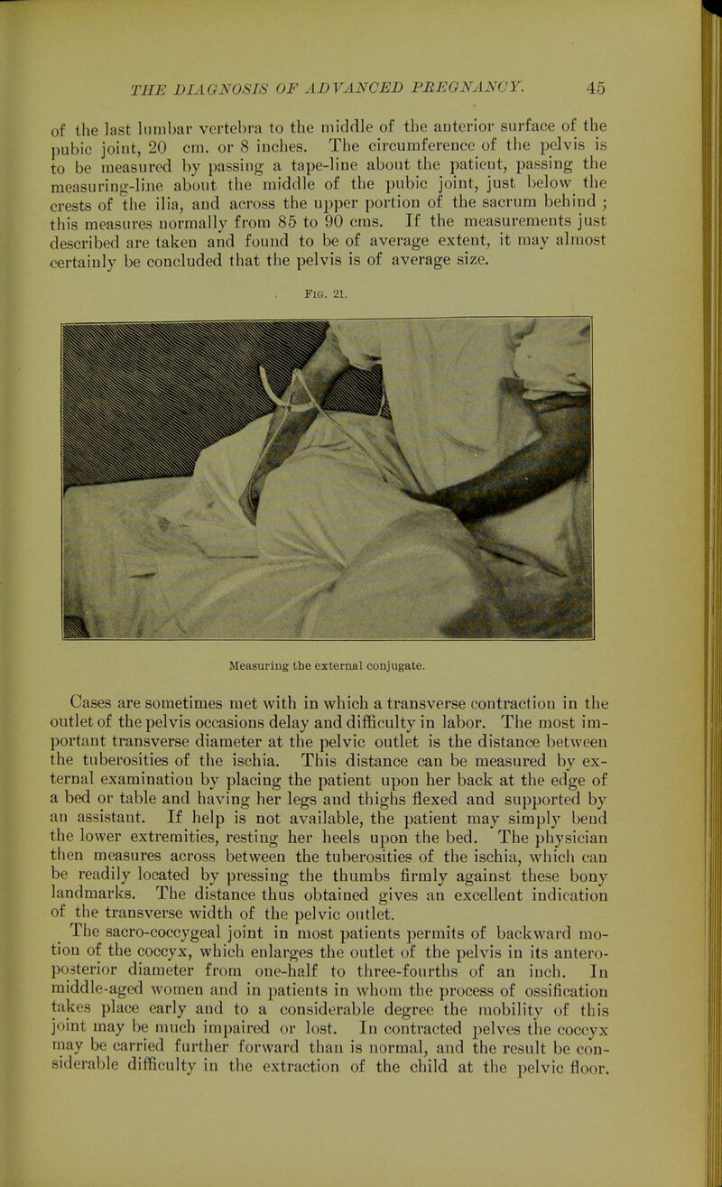 of the last lumbar vertebra to the middle of the anterior surface of the pubic joint, 20 cm. or 8 inches. The circumference of the pelvis is to be measured by passing a tape-liue about the patient, passing the measuring-line about the middle of the pubic joint, just below the crests of the ilia, and across the upper portion of the sacrum behind ; this measures normally from 85 to 90 cms. If the measurements just described are taken and found to be of average extent, it may almost certainly be concluded that the pelvis is of average size. Fig. 21. Measuring the external conjugate. Cases are sometimes met with in which a transverse contraction in the outlet of the pelvis occasions delay and difficulty in labor. The most im- portant transverse diameter at the pelvic outlet is the distance between the tuberosities of the ischia. This distance can be measured by ex- ternal examination by placing the patient upon her back at the edge of a bed or table and having her legs and thighs flexed and supported by an assistant. If help is not available, the patient may simply bend the lower extremities, resting her heels upon the bed. The physician then measures across between the tuberosities of the ischia, which can be readily located by pressing the thumbs firmly against these bony landmarks. The distance thus obtained gives an excellent indication of the transverse width of the pelvic outlet. The sacro-coccygeal joint in most patients permits of backward mo- tion of the coccyx, which enlarges the outlet of the pelvis in its antero- posterior diameter from one-half to three-fourths of an inch. In middle-aged women and in patients in whom the process of ossification takes place early and to a considerable degree the mobility of this joint may be much impaired or lost. In contracted pelves the coccyx may be carried further forward than is normal, and the result be con- siderable difficulty in the extraction of the child at the pelvic floor.