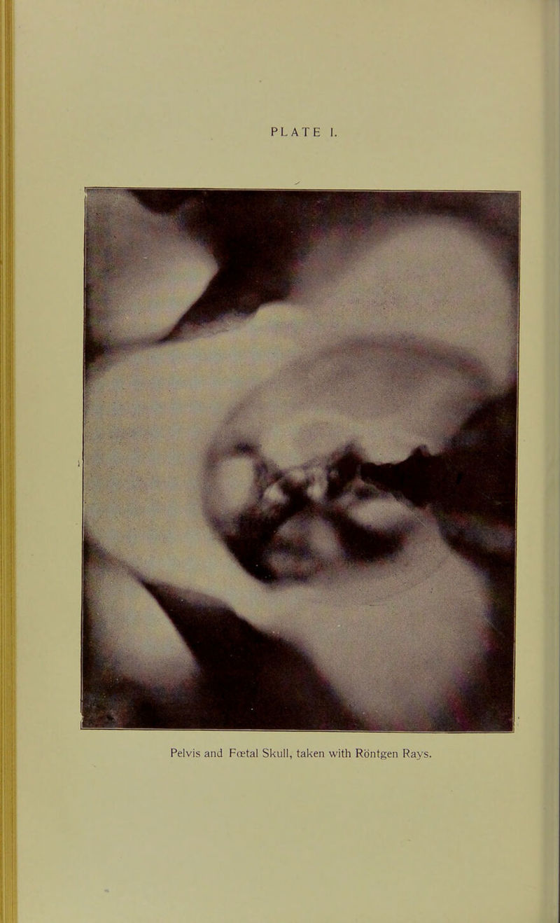 PLATE I. Pelvis and Fcetal Skull, taken with Rbntgen Rays.
