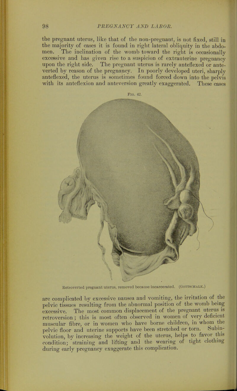 the pregnant uterus, like that of the non-pregnant, is not fixed, still in the majority of cases it is found in right lateral obliquity in the abdo- men. The inclination of the womb toward the right is occasionally excessive and has given rise to a suspicion of extrauterine pregnancy upon the right side. The pregnant uterus is rarely anteflexed or ante- verted by reason of the pregnancy. In poorly developed uteri, sharply anteflexed, the uterus is sometimes found forced down into the pelvis with its anteflexion and anteversion greatly exaggerated. These cases Fig. 42. Retroverted pregnant uterus, removed because incarcerated. (Gottschalk.) are complicated by excessive nausea and vomiting, the irritation of the pelvic tissues resulting from the abnormal position of the womb being excessive. The most common displacement of the pregnant uterus is retroversion ; this is most often observed in women of very deficient muscular fibre, or in women who have borne children, in whom the pelvic floor and uterine supports have been stretched or torn. Subin- volution, by increasing the weight of the uterus, helps to favor this condition; straining and lifting and the wearing of tight clothing during early pregnancy exaggerate this complication.