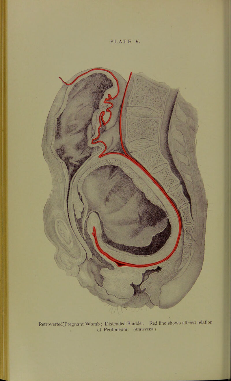 PLATE V. Retroverted]Pregnant Womb ; Distended Bladder. Red line shows altered relation of Peritoneum. (Schwyzer.)