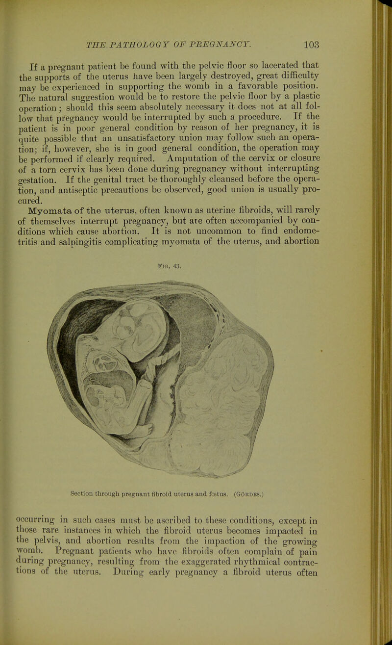 If a pregnant patient be found with the pelvic floor so lacerated that the supports of the uterus have been largely destroyed, great difficulty may be experienced in supporting the womb in a favorable position. The natural suggestion would be to restore the pelvic floor by a plastic operation; should this seem absolutely necessary it does not at all fol- low that pregnancy would be interrupted by such a procedure. If the jDatient is in poor general condition by reason of her pregnancy, it is quite possible that an unsatisfactory union may follow such an opera- tion; if, however, she is in good general condition, the operation may- be performed if clearly required. Amputation of the cervix or closure of a torn cervix has been done during pregnancy without interrupting gestation. If the genital tract be thoroughly cleansed before the opera- tion, and antiseptic precautious be observed, good union is usually pro- cured. Myomata of the uterus, often known as uterine fibroids, will rarely of themselves interrupt pregnancy, but are often accompanied by con- ditions which cause abortion. It is not uncommon to find endome- tritis and salpingitis complicating myomata of the uterus, and abortion Fig. 43. Section through pregnant fibroid uterus and foetus. (GOrdks.) occurring in such cases must be ascribed to these conditions, except in those rare instances in which the fibroid uterus becomes impacted in the pelvis, and abortion results from the impaction of the growing womb. Pregnant patients who have fibroids often complain of pain during pregnancy, resulting from the exaggerated rhythmical contrac- tions of the uterus. During early pregnancy a fibroid uterus often
