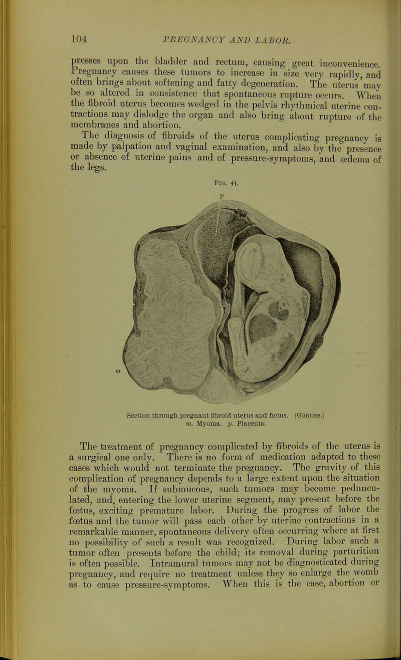 presses iipou the bladder and rectum, causing great inconvenience. Pregnancy causes these tumors to increase in size very rapidly, and often brings about softening and fatty degeneration. The uterus'may be so altered in consistence that spontaneous rupture occurs. When the fibroid uterus becomes wedged in the pelvis rhythmical uterine con- tractions may dislodge the organ and also bring about rupture of the membranes aud abortion. The diagnosis of fibroids of the uterus complicating pregnancy is made by palpation and vaginal examination, and also by the presence or absence of uterine pains and of pressure-symptoms, and oedema of the legs. Fig. 44. p Section through pregnant fibroid uterus and foetus. (GOrdes.) m. Myoma, p. Placenta. The treatment of pregnancy complicated by fibroids of the uterus is a surgical one only. There is no form of medication adapted to these cases which would not terminate the pregnancy. The gravity of this complication of pregnancy depends to a large extent upon the situation of the myoma. If submucous, such tumors may become peduncu- lated, and, entering the lower uterine segment, may present before the foetus, exciting premature labor. During the progress of labor the foetus and the tumor will pass each other by uterine contractions in a remarkable manner, spontaneous delivery often occurring where at first no possibility of such a result was recognized. During labor such a tumor often presents before the child; its removal during parturition is often possible. Intramural tumors may not be diagnosticated during pregnancy, and require no treatment unless they so enlarge the womb as to cause pressure-symptoms. When this is the case, abortion or