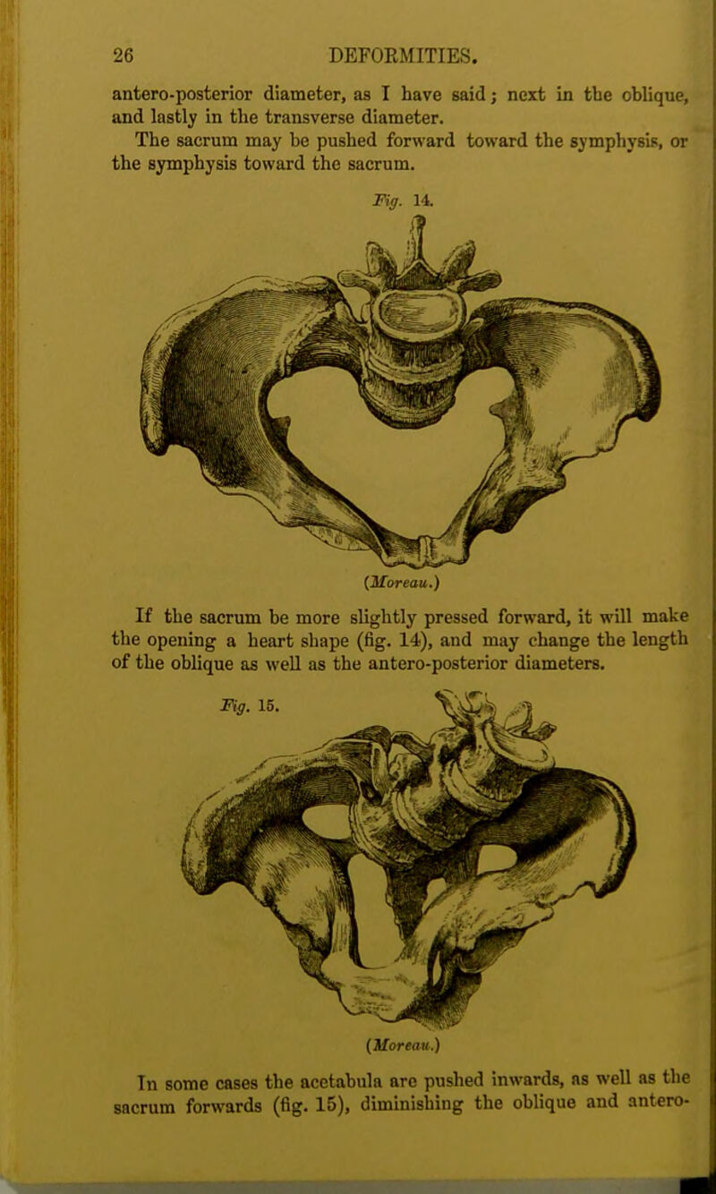 antero-posterior diameter, as I have said j next in the oblique, and lastly in the transverse diameter. The sacrum may be pushed forward toward the symphysis, or the symphysis toward the sacrum. Fig. 14. {Moreau.) If the sacrum be more slightly pressed forward, it will make the opening a heart shape (fig. 14), and may change the length of the oblique as well as the antero-posterior diameters. (Moreau.) In some cases the acetabula are pushed inwards, as well as the sacrum forwards (fig. 15), diminishing the oblique and antero-