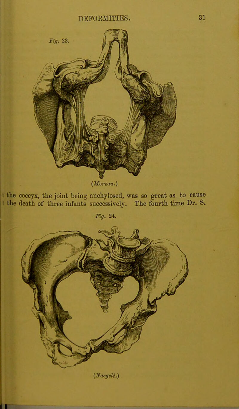 I the coccyx, the joint being anchylosed, was so great as to cause ' the death of three infants successively. The fourth time Dr. S. Fig. 24. I