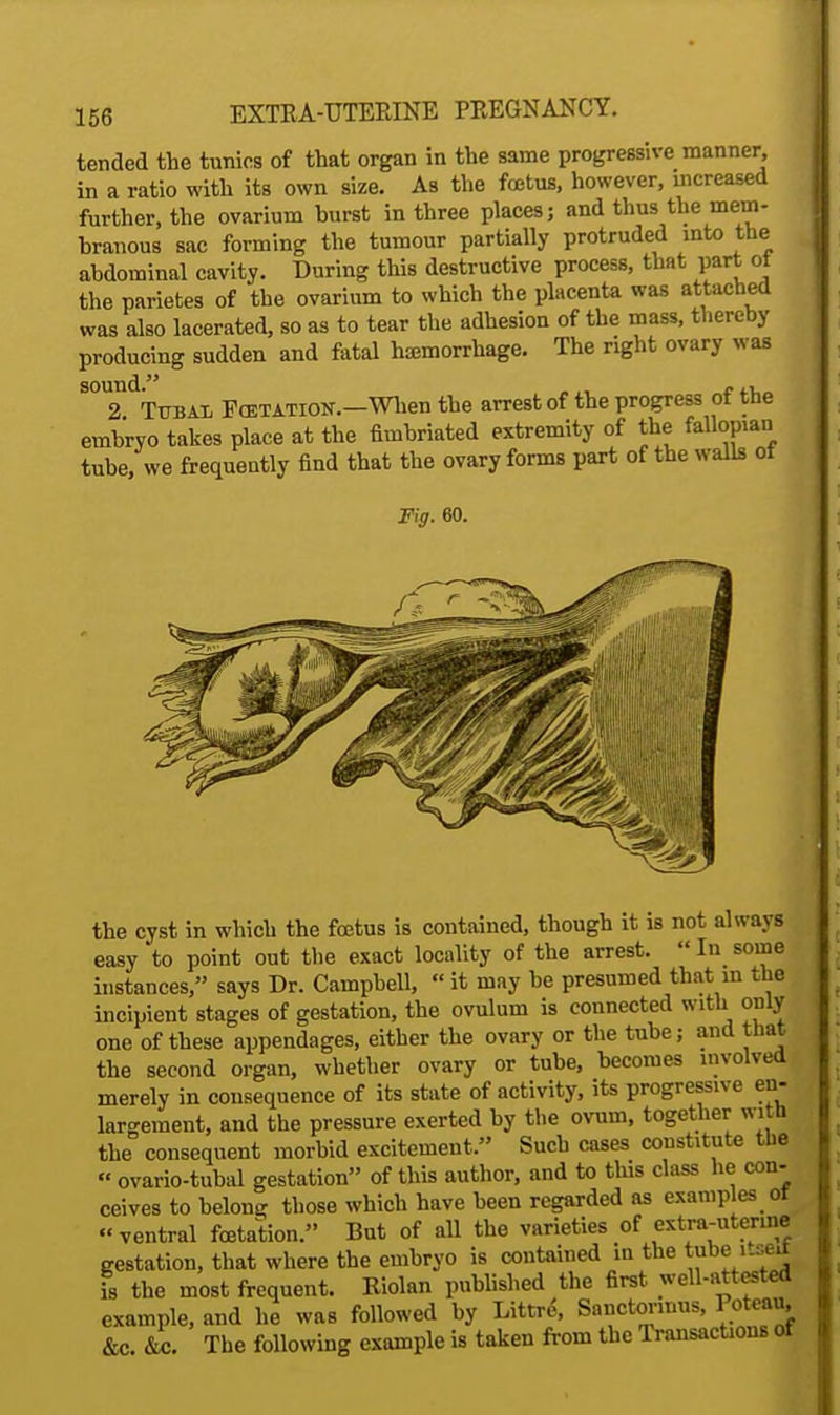 tended the tunics of that organ in the same progressn-e manner in a ratio with its own size. As the foetus, however, increased further, the ovarium hurst in three places; and thus the mem- branous sac forming the tumour partially protruded into the abdominal cavity. During this destructive process, that part ot the parietes of the ovarium to which the placenta was attached was also lacerated, so as to tear the adhesion of the mass, thereby producing sudden and fatal hemorrhage. The right ovary was ^T^tjbai Ecetation.—When the arrest of the progress of the embryo takes place at the fimbriated extremity of the fallopian tube, we frequently find that the ovary forms part of the walls ot Fig. 60. the cyst in which the foetus is contained, though it is not always easy to point out the exact locality of the arrest.  In some instances, says Dr. Campbell,  it may be presumed that in the incipient stages of gestation, the ovulum is connected with only one of these appendages, either the ovary or the tube; and that the second organ, whether ovary or tube, becomes involved merely in consequence of its state of activity, its progressive en- largement, and the pressure exerted by the ovum, together with the consequent morbid excitement. Such cases constitute the « ovario-tubal gestation of this author, and to this class he con- ceives to belong those which have been regarded as examples or ventral foetation. But of all the varieties of extra-uterine gestation, that where the embryo is contained in the tube i-seu is the most frequent. Riolan published the first well-attested example, and he was followed by Liter*, Sanctorinus, Poteau, &c. 4c. The following example is taken from the Transactions of