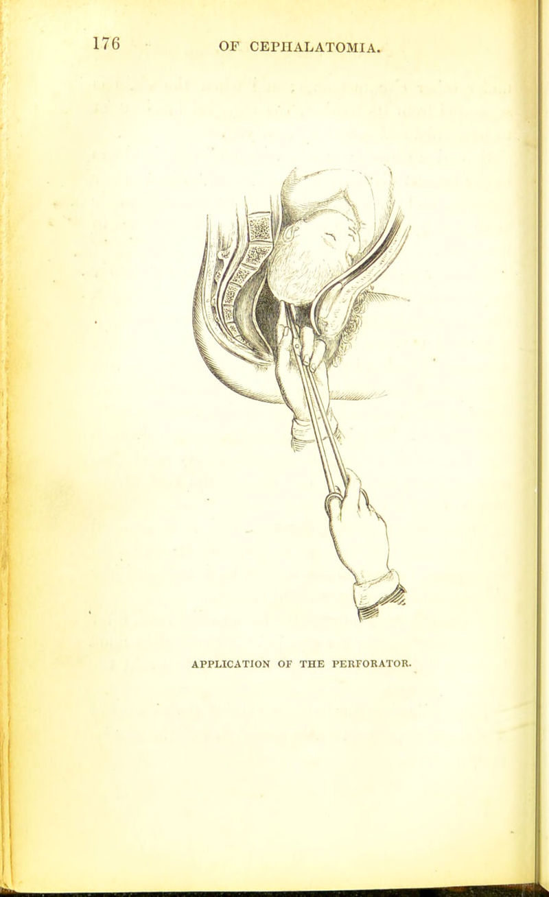 APPLICATION OF THE PERFORATOR.