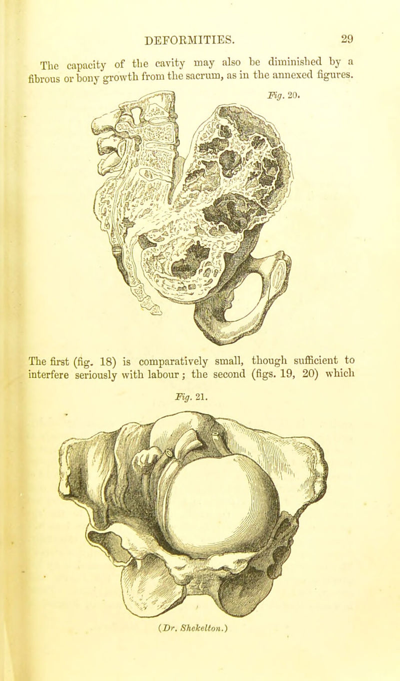 The capacity of tlie cavity may also be diminished by a fibrous 01- bony growth from the sacrum, as in the annexed figures. The first (fig. 18) is comparatively small, though sufficient to interfere seriously with labour; the second (figs. 19, 20) which Fig. 21. (Dr. Shekellon.)