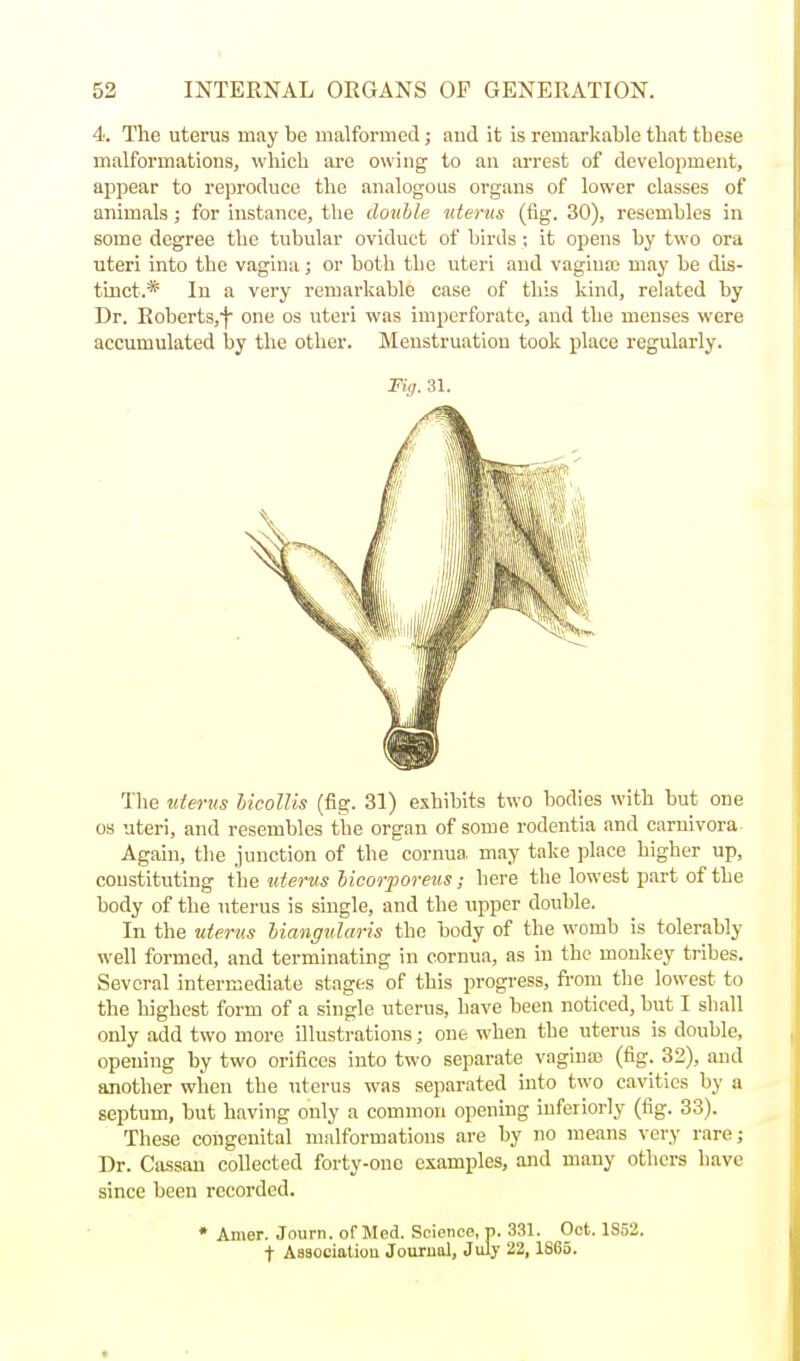 4. The uterus may be malformed; and it is remarkable that these malformations, which are owing to an ai-rest of development, appear to reproduce the analogous organs of lower classes of animals; for instance, the double litems (fig. 30), resembles in some degree the tubular oviduct of birds; it opens by two ora uteri into the vagina; or both the uteri and vagina; may be dis- tinct.* In a very remarkable case of this kind, related by Dr. Roberts,')* one os uteri was imperforate, and the menses were accumulated by the other. Menstruation took place regularly. Fig. 31. The ideriis hicolUs (fig. 31) exhibits two bodies with but one OS uteri, and resembles the organ of some rodentia and caruivora Again, the junction of the cornua, may take place higher up, constituting the -uterus bicorporeus; here the lowest part of the body of the uterus is single, and the upper double. In the uterus biangularis the body of the womb is tolerably well formed, and terminating in cornua, as in the monkey tribes. Several intermediate .stages of this progress, fi-om the lowest to the highest form of a single uterus, have been noticed, but I shall only add two more illustrations; one when the uterus is double, opening by two orifices into two separate vaginas (fig. 32), and another when the uterus was separated into two cavities by a septum, but having only a common opening inferiorly (fig. 33). These congenital malformations are by no means very rare; Dr. Cassau collected forty-one examples, and many others have since been recorded. • Anier. Journ. of Med. Science, p. 331. Oct. 1S52. f Asaociatiou Jourual, Julj 22, 1865.