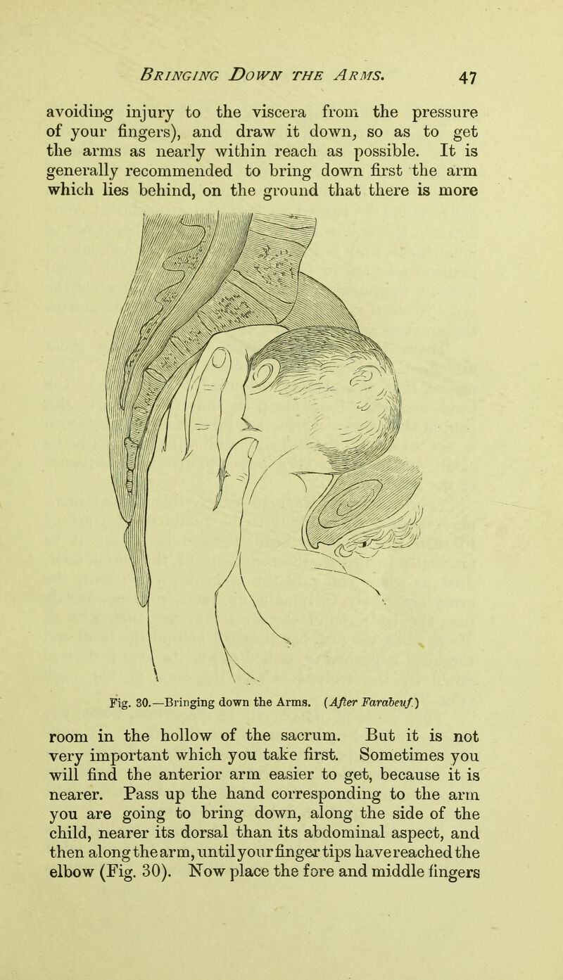 Bringing Down the Arms. avoiding injury to the viscera from the pressure of your fingers), and draw it down, so as to get the arms as nearly within reach as possible. It is generally recommended to bring down first the arm which lies behind, on the ground that there is more Fig. 30.—Bringing down the Arms. (After Fardbenf.) room in the hollow of the sacrum. But it is not very important which you take first. Sometimes you will find the anterior arm easier to get, because it is nearer. Pass up the hand corresponding to the arm you are going to bring down, along the side of the child, nearer its dorsal than its abdominal aspect, and then along the arm, until your finger tips have reached the elbow (Fig. 30). Now place the fore and middle fingers