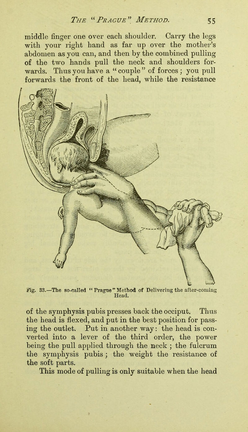 middle finger one over each shoulder. Carry the legs with your right hand as far up over the mother's abdomen as you can, and then by the combined pulling of the two hands pull the neck and shoulders for- wards. Thus you have a  couple  of forces; you pull forwards the front of the head, while the resistance Head. of the symphysis pubis presses back the occiput. Thus the head is flexed, and put in the best position for pass- ing the outlet. Put in another way: the head is con- verted into a lever of the third order, the power being the pull applied through the neck ; the fulcrum the symphysis pubis; the weight the resistance of the soft parts. This mode of pulling is only suitable when the head