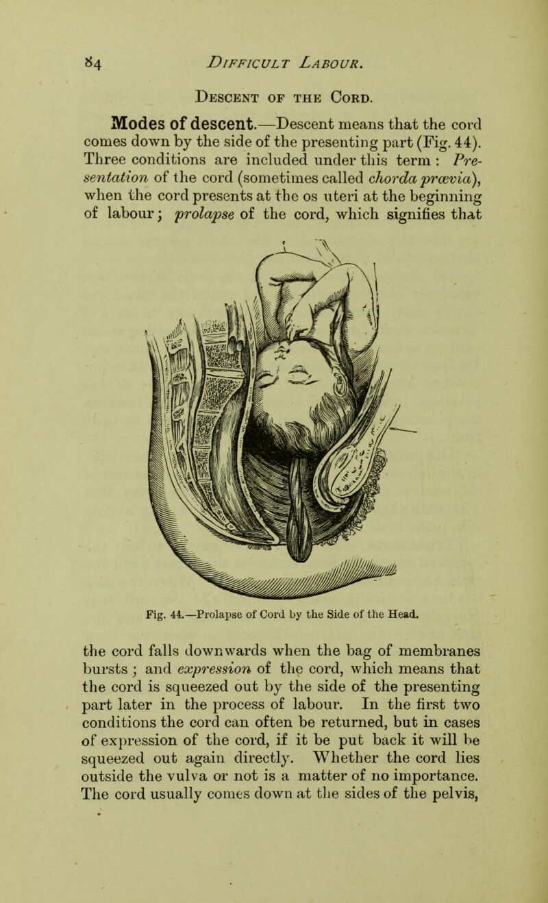 Descent of the Cord. Modes of descent.—Descent means that the cord comes down by the side of the presenting part (Fig. 44). Three conditions are included under this term : Pre- sentation of the cord (sometimes called chorda prcevia), when the cord presents at the os uteri at the beginning of labour; prolapse of the cord, which signifies that Fig. 44.—Prolapse of Cord by the Side of the Head. the cord falls downwards when the bag of membranes bursts ; and expression of the cord, which means that the cord is squeezed out by the side of the presenting part later in the process of labour. In the first two conditions the cord can often be returned, but in cases of expression of the cord, if it be put back it will be squeezed out again directly. Whether the cord lies outside the vulva or not is a matter of no importance. The cord usually comes down at the sides of the pelvis,