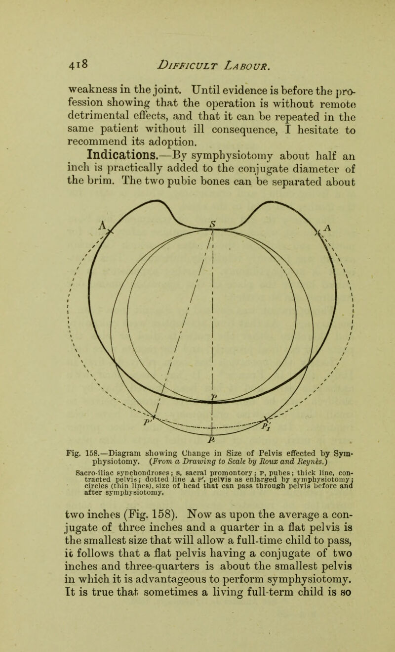 weakness in the joint. Until evidence is before the pro- fession showing that the operation is without remote detrimental effects, and that it can be repeated in the same patient without ill consequence, I hesitate to recommend its adoption. Indications.—By symphysiotomy about half an inch is practically added to the conjugate diameter of the brim. The two pubic bones can be separated about Fig. 158.—Diagram showing Change in Size of Pelvis effected by Sym- physiotomy. (From a Drawing to Scale by Boux and Reynks.) Sacro iliac synchondroses; s, sacral promontory; p, puhes; thick line, con- tracted pelvis; dotted line A p', pelvis as enlarged by symphysiotomy; circles (thin lines), size of head that can pass through pelvis before and after symphysiotomy. two inches (Fig. 158). Now as upon the average a con- jugate of three inches and a quarter in a flat pelvis is the smallest size that will allow a full-time child to pass, ic follows that a flat pelvis having a conjugate of two inches and three-quarters is about the smallest pelvis in which it is advantageous to perform symphysiotomy. It is true that sometimes a living full-term child is so