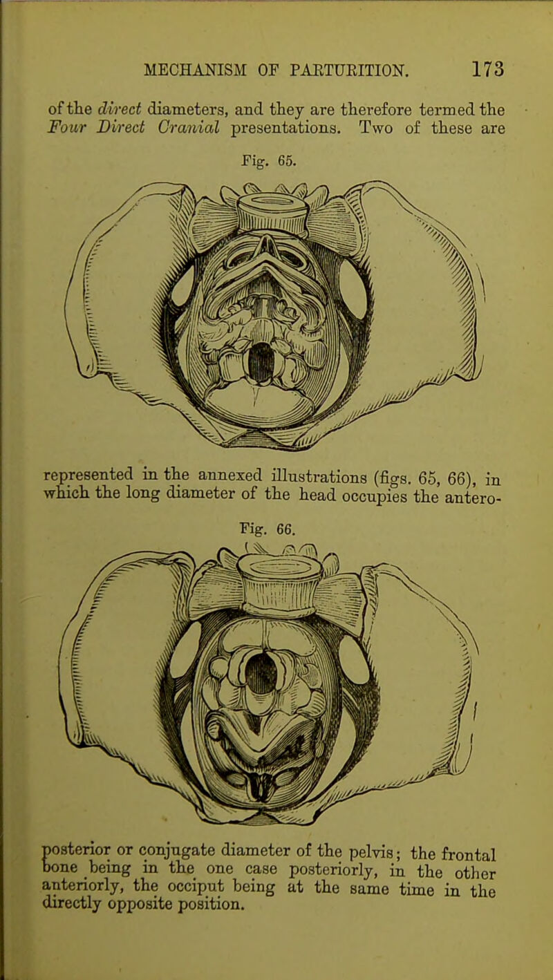 of the direct diameters, and they are therefore termed the Four Direct Cranial presentations. Two of these are Fig. 65. represented in the annexed illustrations (figs. 65, 66), in which the long diameter of the head occupies the antero- Fig. 66. posterior or conjugate diameter of the pelvis; the frontal bone being in the one case posteriorly, in the other anteriorly, the occiput being at the same time in the directly opposite position.