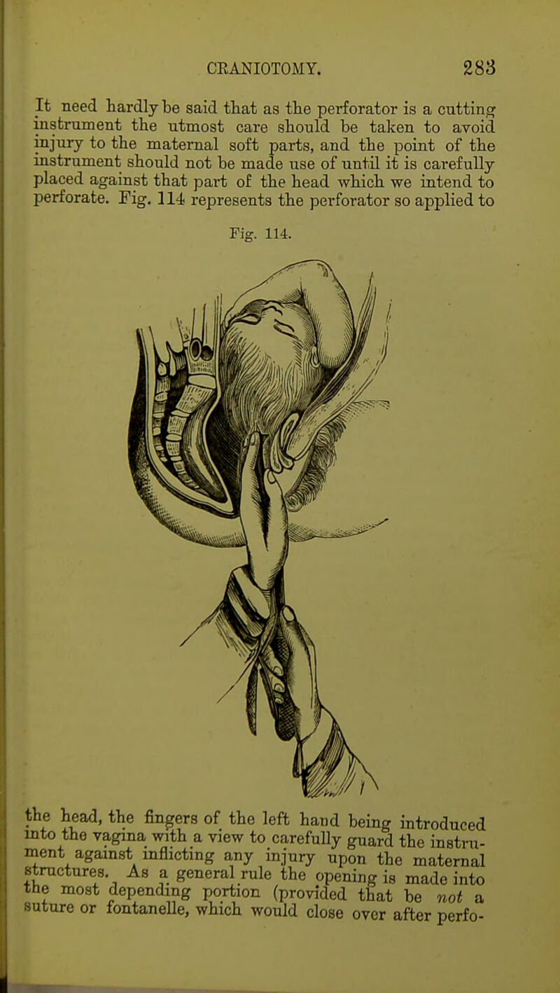 It need hardly be said that as the perforator is a cutting instrument the utmost care should be taken to avoid injury to the maternal soft parts, and the point of the instrument should not be made use of until it is carefully placed against that part of the head which we intend to perforate. Fig. 114 represents the perforator so applied to Fig. 114. the head, the fingers of the left hand being introduced into the vagina with a view to carefully guard the instru- ment against inflicting any injury upon the maternal structures. As a general rule the opening is made into the most depending portion (provided that be not a suture or fontanelle, which would close over after perfo-