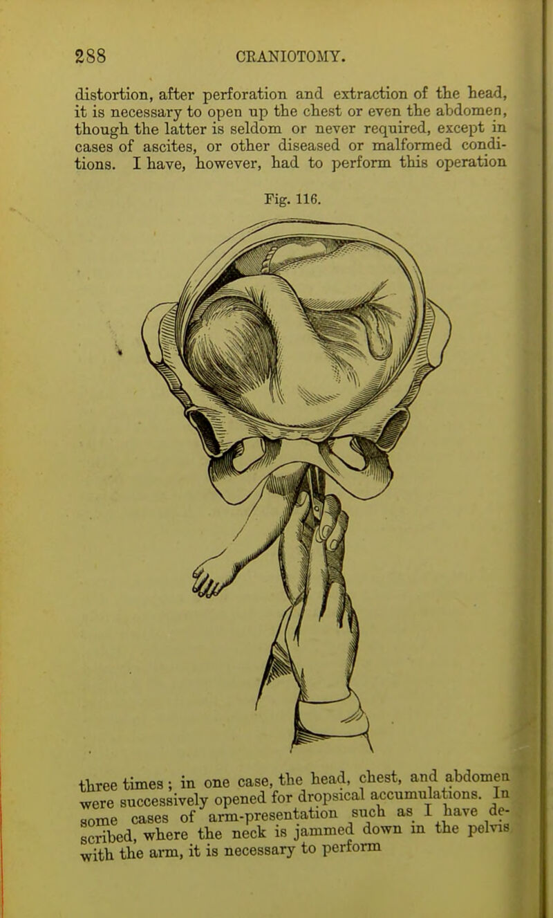 distortion, after perforation and extraction of the head, it is necessary to open np the chest or even the abdomen, though the latter is seldom or never required, except in cases of ascites, or other diseased or malformed condi- tions. I have, however, had to perform this operation Fig. 116. three times; in one case, the head, chest, and abdomen were successively opened for dropsical accumulations. In some cases of arm-presentation such as I have de- scribed, where the neck is jammed down in the pelvis with the arm, it is necessary to perform