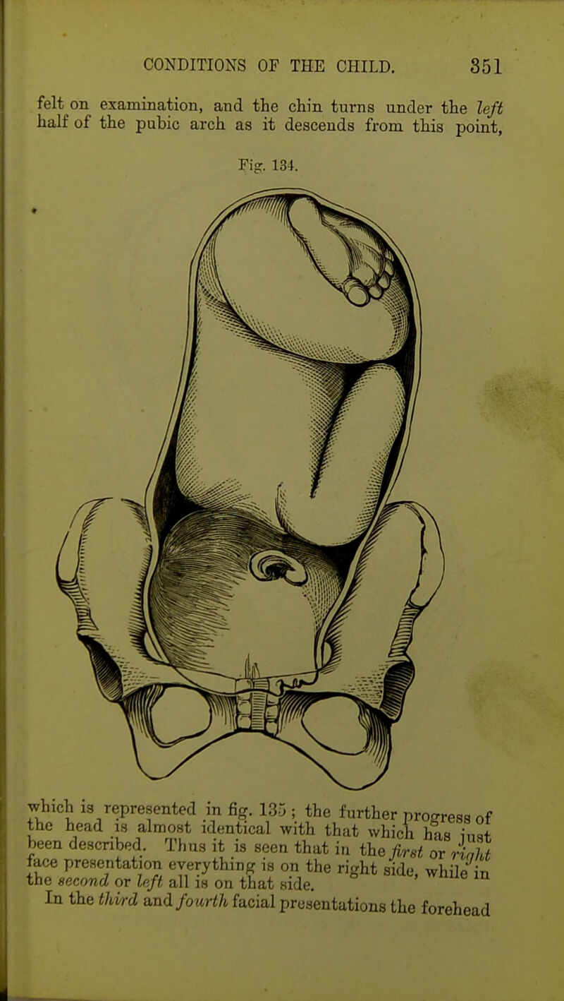 felt on examination, and the chin turns under the left half of the pubic arch as it descends from this point, Fig. 134. which is represented m fig. 135; the further progress of the head is almost identical with that which has insr been described. Thus it is seen that in the first or riaht face presentation everything is on the right side while it, the second or left all is on that side. ' G m In the third and fourth facial presentations the forehead