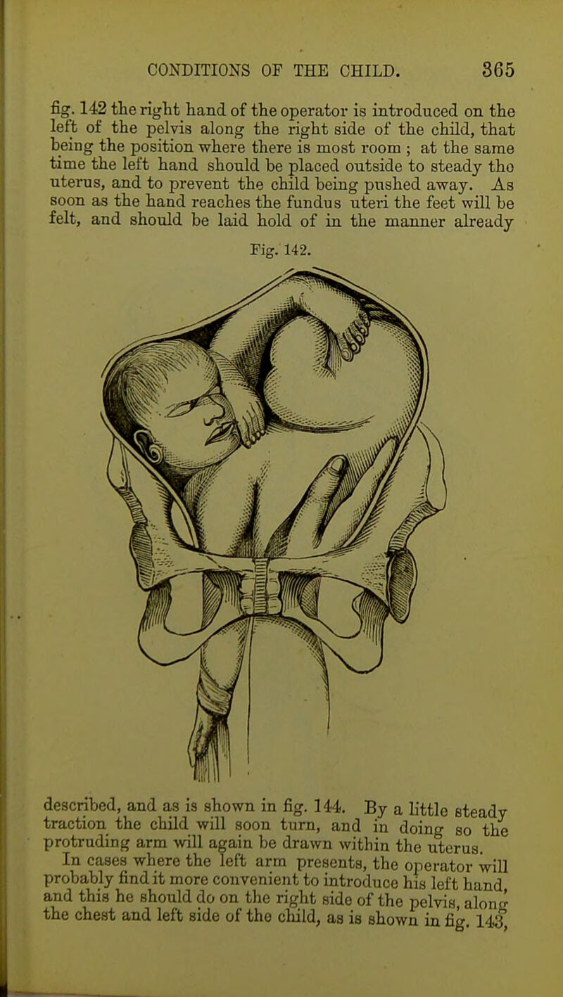 fig. 142 the right hand of the operator is introduced on the left of the pelvis along the right side of the child, that being the position where there is most room ; at the same time the left hand should be placed outside to steady tho uterus, and to prevent the child being pushed away. As soon as the hand reaches the fundus uteri the feet will be felt, and should be laid hold of in the manner already Fig. 142. described, and as is shown in fig. 144. By a little steady traction the child will soon turn, and in doing so the protruding arm will again be drawn within the uterus. In cases where the left arm presents, the operator will probably find it more convenient to introduce his left hand and this he should do on the right side of the pelvis, along the chest and left side of tho child, as is shown in fig. 143