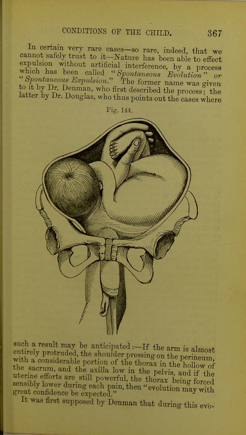 In certain very rare cases-so rare, indeed, that we cannot safely trust to it-Nature has been able to effect wl?5fT ^th°Ut ^6cial inference, by a process which has been called Spontaneous Evolution or Spontaneous Expulsion. He former name was given ZUl £ °enmf' wh° fi}-3t Ascribed the process! the latter by Dr. Douglas, who thus points out the cases where such a result may be anticipated:—If the arm i„ entirely protruded, the shoulder pressing on KJriJSSf with a considerable portion of the thorax in ffiR the sacrum, and the axilla low in the pelvis nnrl f *£l ntenne efforts are.still powerful, the thomx being forced ensibly lower during each pain, then evolution may with great confidence be expected. 7 th It was first supposed by Denman that during this evb-