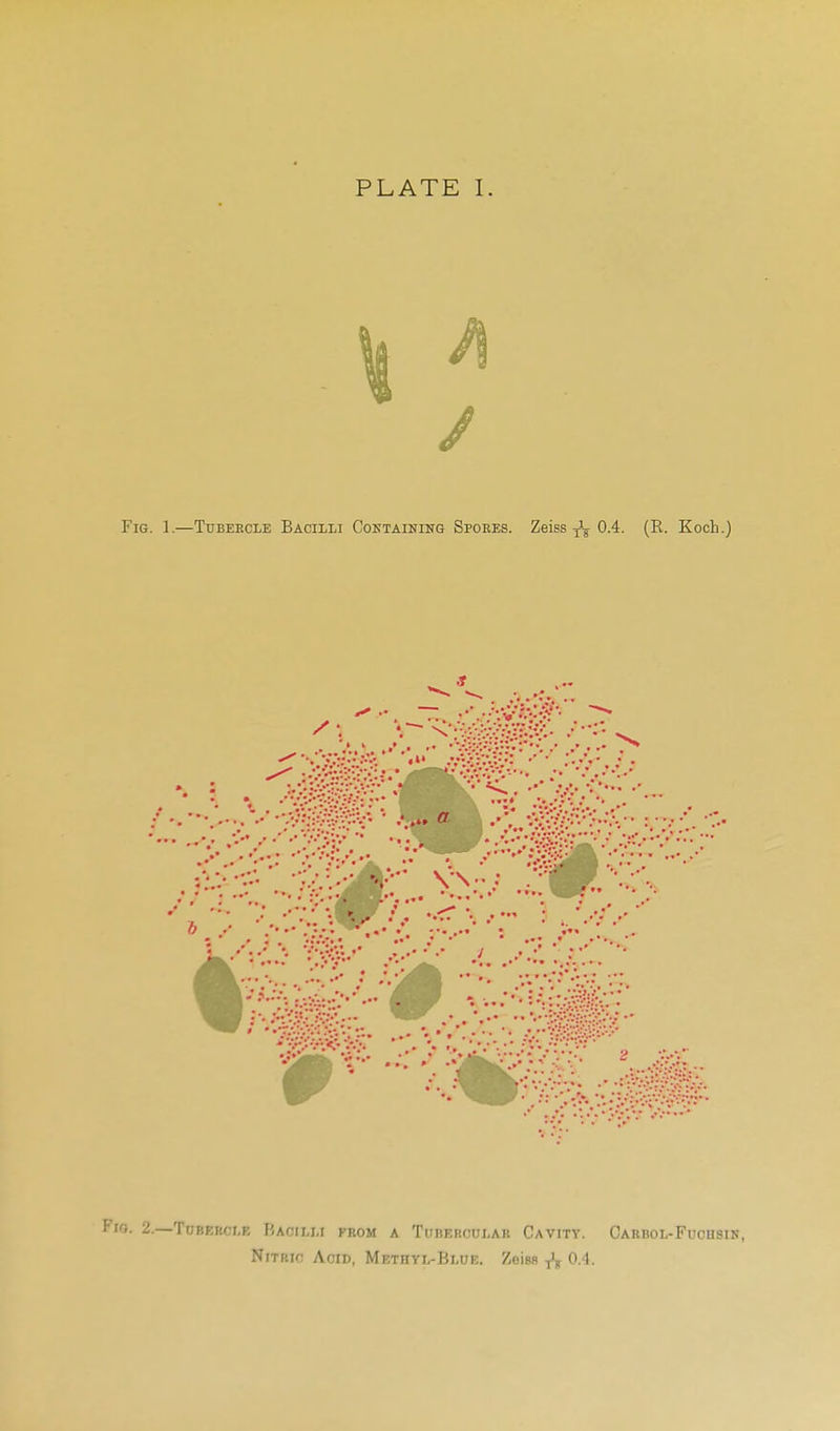 FlO. 2.—TUBEKCI.K P.ACILM FROM A TuBEKCUI-Alt CaVITY. Nitric Acid, Methyl-Blue. ZoiBR 0.1. Caubol-Fuohsin,