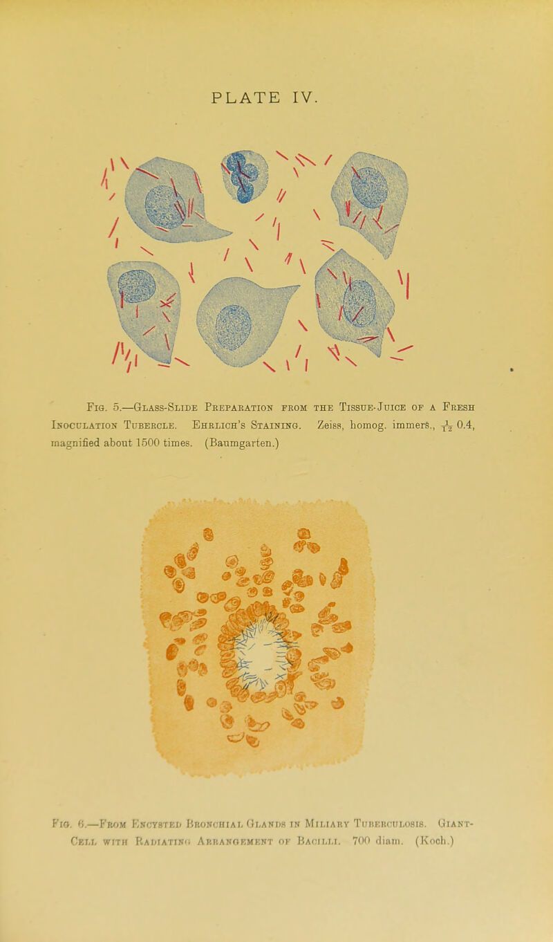 Fig. 5.—Glass-Slide Peepaeation feom the Tissue. Juice of a Fresh IsoccLATioN Tubercle. Ehelich's Staining. Zeiss, homog. immers., 0.4, magnified about 1500 times. (Baumgarten.) Fig. ^^}.—From EscraTEii Bkoschiai. Glakds in Miliary Tuberculosis. Giant- Cell wrxff Radiatin'i Abbangrment of Bacilli. 700 diam. (Koch.)