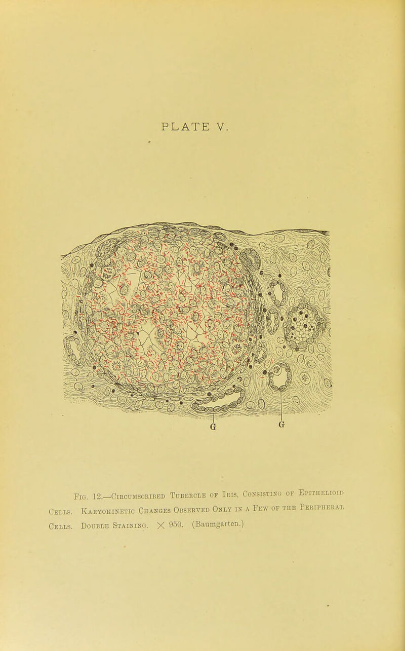 PLATE V. Fig. 12.—Circumscribed Tubeecle of Iris, Consisting of Ei-ithelioip Cells. Karyokinetic Changes Observed Only in a Few of the Peripheral Cells. Double Staining. X S-'^O. (Baumgarten.)