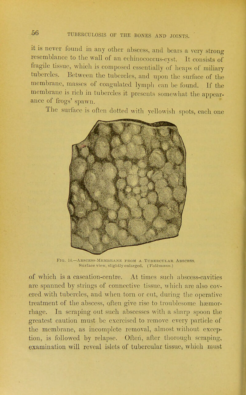 it is never found in any other abscess, and bears a very strong resemblance to the wall of an echhiococcus-cyst. It consists of fragile tissue, which is composed essentially of lieai)s ol miliary tubercles. Between the tubercles, and upon the surface of the membrane, masses of coagulated lympli can be found. If the membrane is rich in tubercles it presents somewhat the appear- ance of frogs' spawn. The surface is often dotted with yellowish spots, each one Fig. 11.—Absces.s-Ml,.muuane feiom a TunERcur,AK Abscess. Surface view, slightly enlarged. (Vollcinann.) of which is a caseation-centre. At times such abscess-cavities are spanned by strings of connective tissue, wliich are also cov- ered with tubercles, and when torn or cut, during tlie operative treatment of the abscess, often give rise to troublesome hajmor- rhage. In scraping out such abscesses with a sharp spoon tlie greatest caution must be exercised to remove every particle of the membrane, as incomplete removal, almost Avitliout excep- tion, is followed by relapse. Oftcii, after tliorough scraping, examination will reveal islets of tubercular tissue, which nuist