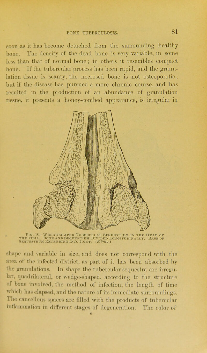 soon as it lias become detached from the siirroundrng healthy- bone. The density of the dead bone is very variable, in some less than that of normal bone; in others it resembles compact bone. If the tubercnlar process has been rapid, and the granu- lation tissue is scanty, the necrosed bone is not osteoporotic; but if the disease has pursued a more chronic course, and has resulted in the production of an abundance of granulation tissue, it presents a honey-combed appearance, is irregular in Fig. 18.—Weege-shapkd Tuhekcular Sequestrum in the Head of THETiBrA. Bone AND Sequestkum Divided Longitudinally. Base of SECit;E.STKU.H Ex TENDING INTO JOINT. (Kuuig.) shape and variable in size, and does not correspond with the area of the infected district, as part of it has been absorbed by the granulations. In shape the tubercular sequestra are irregu- lar, quadrilateral, or wedge-shaped, according to the structure of bone involved, the method of infection, the length of time which has elapsed, and the nature of its immediate surroundings. The cancellous spaces are filled with the products of tubercular inflammation in different stages of degeneration. The color of 6