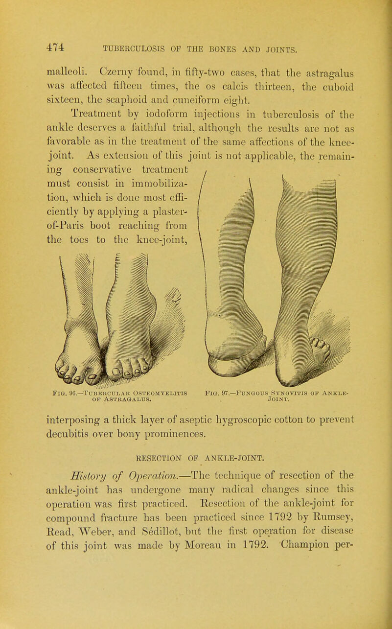 malleoli. Czerny found, in fifty-two cases, that the astragalus was affected fifteen times, the os calcis thirteen, the cuboid sixteen, the scaphoid and cuneiform eight. Treatment by iodoform injections in tuberculosis of the ankle deserves a faithful trial, although the results are not as favorable as in the treatment of the same affections of the knee- joint. As extension of this joint is not applicable, the remain- FiG. 9G.—Tubercular Osteomyelitis Fig. 97.—Fungous .Synovitis of Ankle- OF Astragalus. Joint. interposing a thick layer of aseptic hygroscopic cotton to prevent decubitis over bony prominences. RESECTION OF ANKLE-JOINT. History of Operation.—The technique of resection of the ankle-joint has undergone many radical changes since this operation was first practiced. Resection of the ankle-joint for compound fracture has been practiced since 1792 by Rumsey, Read, Weber, and Sedillot, but the first operation for disease of this joint was made by Moreau in 1792. Champion per-