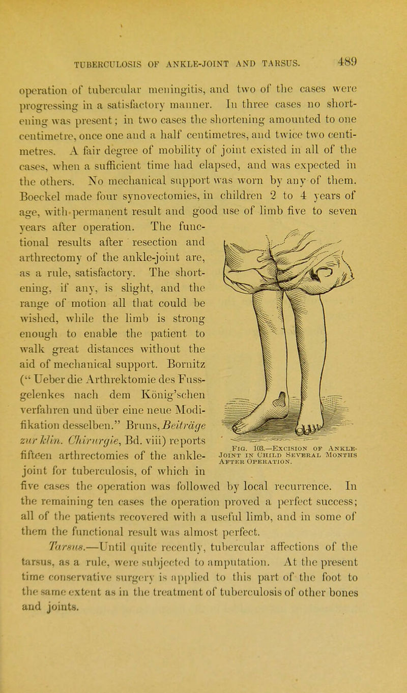 operation of tubercular meningitis, and two of tlie cases were progressing in a satisfactory manner. In three cases no short- ening was present; in two cases the shortening amounted to one centimetre, once one and a half centimetres, and twice two centi- metres. A fair degree of mobility of joint existed in all of the cases, when a sufficient time had elapsed, and was expected in the others. No mechanical support was worn by any of them. Boeckel made four synovectomies, in children 2 to 4 years of age, with permanent result and good use of limb five to seven years after operation. The func- tional results after resection and arthrectomy of the ankle-joint are, as a rule, satisfactory. The short- ening, if any, is slight, and the ranjj-e of motion all that could be wished, while the limb is strong enough to enable the patient to walk great distances without the aid of mechanical support. Bornitz Ueber die Arthrektomie des Fuss- gelenkes nach dem Konig'schen verfahren und iiber eine neue Modi- fikation des.selben. Bi'unfi, Beitrdge zurJcIin. Chirurgie, Bd. viii) reports fifteen arthrectomies of the ankle- joint for tuberculosis, of which in five cases the operation was followed by local recurrence. In the remaining ten cases the operation proved a perfect success; all of the patients recovered with a useful limb, and in some of them the functional result was almost perfect. Tarsus.—Until quite recently, tubercular affections of the tfir.sus, as a rule, were subjected to amputation. At the present time con.servative surgery is jipplied to this part of the foot to the same extent as in the treatment of tuberculosis of other bones and joints. Fig. 103.—Excision of Ankie- JoiNT IN Child Several, Months After Operation.