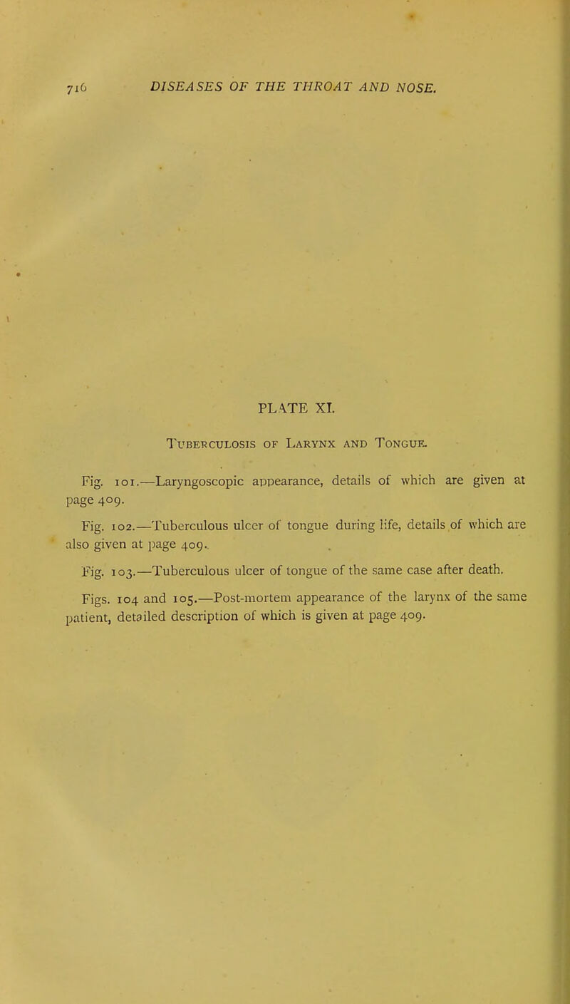 PL \TE XI. TUBE'RCULOSIS OF LaRYNX AND TONGUE. Fig. loi.—Laryngoscopic appearance, details of which are given at page 409- Fig. 102.—Tuberculous ulcer of tongue during life, details of which are also given at page 409.. Fig. 103.—Tuberculous ulcer of tongue of the same case after death. Figs. 104 and 105.—Post-mortem appearance of the laryn.x of the same patient, detailed description of which is given at page 409.