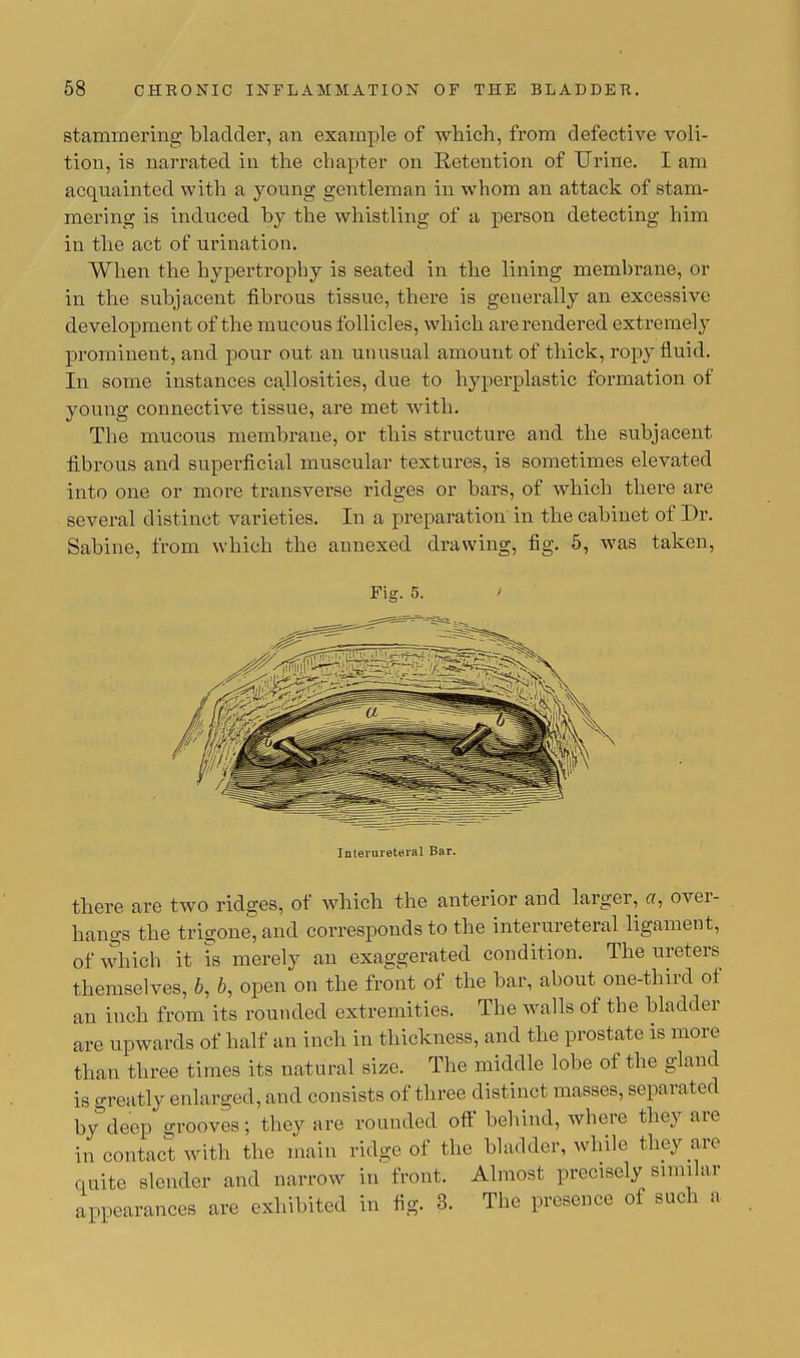 stammering bladder, an example of which, from defective voli- tion, is narrated in the chapter on Retention of Urine. I am acquainted with a young gentleman in whom an attack of stam- mering is induced by the whistling of a person detecting him in the act of urination. When the hypertrophy is seated in the lining membrane, or in the subjacent fibrous tissue, there is generally an excessive development of the mucous follicles, which are rendered extremely prominent, and pour out an unusual amount of thick, ropy fluid. In some instances callosities, due to hyperplastic formation of young connective tissue, are met with. The mucous membrane, or this structure and the subjacent fibrous and superficial muscular textures, is sometimes elevated into one or more transverse ridges or bars, of which there are several distinct varieties. In a preparation in the cabinet of Dr. Sabine, from which the annexed drawing, fig. 5, was taken, Fig. 5. Inteiureteral Bar. there are two ridges, of which the anterior and larger, a, over- hangs the trigone, and corresponds to the inteiureteral-ligament, of which it is merely an exaggerated condition. The ureters themselves, b, b, open on the front of the bar, about one-third of an inch from its rounded extremities. The walls of the bladder are upwards of half an inch in thickness, and the prostate is more than three times its natural size. The middle lobe of the gland is greatly enlarged, and consists of three distinct masses, separated by deep grooves; they are rounded off behind, where they are in contact with the main ridge of the bladder, while they are quite slender and narrow in front. Almost precisely similar appearances are exhibited in fig. 3. The presence of such a