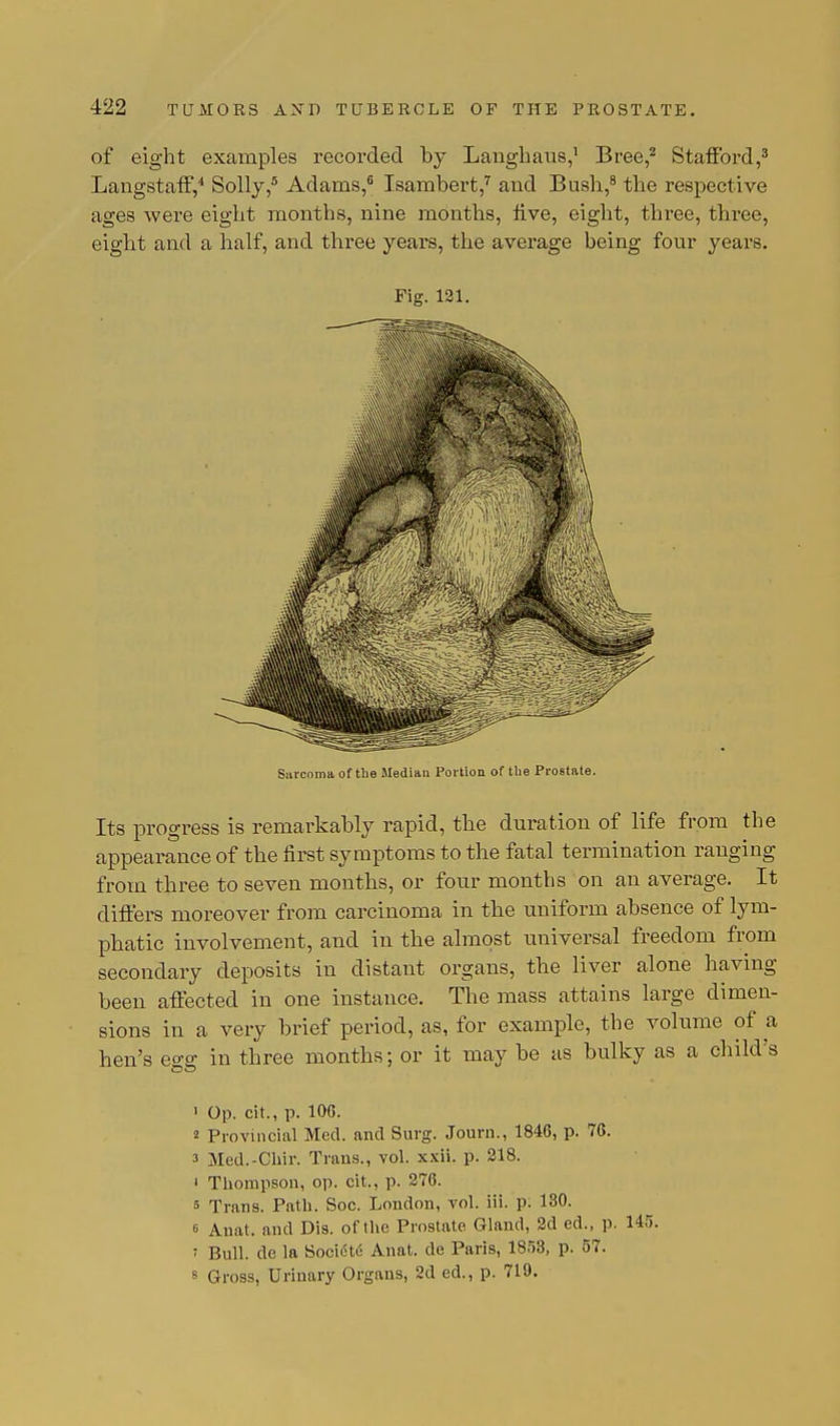 of eight examples recorded by Langhaus,1 Bree,2 Stafford,3 Langstaff,4 Solly,5 Adams,6 Isambert,7 and Bush,8 the respective ages were eight months, nine months, five, eight, three, three, eight and a half, and three years, the average being four years. Fig. 121. Surcoma of tbe Mediau Portion of the Prostate. Its progress is remarkably rapid, the duration of life from the appearance of the first symptoms to the fatal termination ranging from three to seven months, or four months on an average. It differs moreover from carcinoma in the uniform absence of lym- phatic involvement, and in the almost universal freedom from secondary deposits in distant organs, the liver alone having been affected in one instance. The mass attains large dimen- sions in a very brief period, as, for example, the volume of a hen's eo-e in three months; or it may be as bulky as a child's Do ■ Op. cit., p. 10G. 2 Provincial Med. and Surg. Journ., 1846, p. 76. 3 Med.-Chir. Trans., vol. xxii. p. 218. ' Thompson, op. cit., p. 276. s Trans. Path. Soc. London, vol. iii. p. 130. e Auat. and Dis. of the Prostate Gland, 2d ed., p. 145. ' Bull, de la Socicte Anat. de Paris, 1858, p. 57. s Gross, Urinary Organs, 2d ed., p. 719.