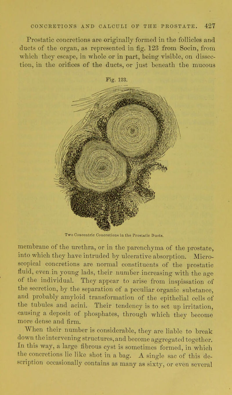 Prostatic concretions are originally formed in the follicles and ducts of the organ, as represented in fig. 123 from Socin, from which they escape, in whole or in part, being visible, on dissec- tion, in the orifices of the ducts, or just beneath the mucous Fig. 123. Two Concentric Concretions in the Prostatic Ducts. membrane of the urethra, or in the parenchyma of the prostate, into which they have intruded by ulcerative absorption. Micro- scopical concretions are normal constituents of the prostatic fluid, even in young lads, their number increasing with the age of the individual. They appear to arise from inspissation of the secretion, by the separation of a peculiar organic substance, and probably amyloid transformation of the epithelial cells of the tubules and acini. Their tendency is to set up irritation, causing a deposit of phosphates, through which they become more dense and firm. When their number is considerable, they are liable to break down the intervening structures, and become aggregated together. In this way, a large fibrous cyst is sometimes formed, in which the concretions lie like shot in a bag. A single sac of this de- scription occasionally contains as many as sixty, or even several