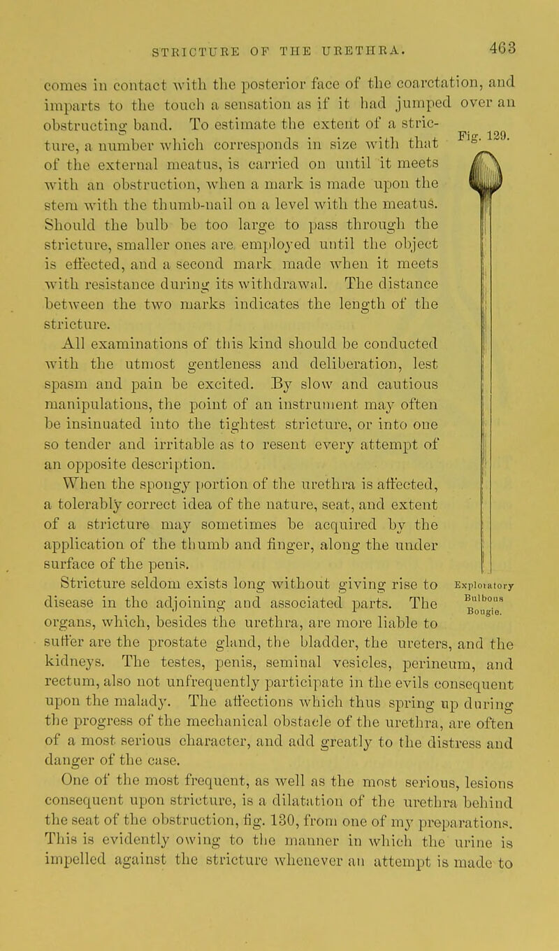 Fig. 129. comes in contact with the posterior face of the coarctation, and imparts to the touch a sensation as if ii had jumped over an obstructing hand. To estimate the extent of a stric- ture, a number which corresponds in size with that of the external meatus, is carried on until it meets with an obstruction, when a mark is made upon the stem with the thumb-nail on a level with the meatus. Should the bulb he too large to pass through the stricture, smaller ones are employed until the object is effected, and a second mark made when it meets with resistance during its withdrawal. The distance between the two marks indicates the length of the stricture. All examinations of this kind should be conducted with the utmost gentleness and deliberation, lest spasm and pain be excited. By slow and cautious manipulations, the point of an instrument may often be insinuated into the tightest stricture, or into one so tender and irritable as to resent every attempt of an opposite description. When the spongy portion of the urethra is affected, a tolerably correct idea of the nature, seat, and extent of a stricture may sometimes be acquired by the application of the thumb and finger, along the under surface of the penis. Stricture seldom exists long without giving rise to disease in the adjoining aucl associated parts. The organs, which, besides the urethra, are more liable to suffer are the prostate gland, the bladder, the ureters, and the kidneys. The testes, penis, seminal vesicles, perineum, and rectum, also not unfrequently participate in the evils consequent upon the malady. The affections which thus spring up during the progress of the mechanical obstacle of the urethra, are often of a most serious character, and add greatly to the distress and danger of the case. One of the most frequent, as well as the most serious, lesions consequent upon stricture, is a dilatation of the urethra behind the sent of the obstruction, fig. 130, from one of mv preparations Tl lis is evidently owing to the manner in which the urine is impelled against the stricture whenever an attempt is made to Exploiatory Bulbous Bougie.