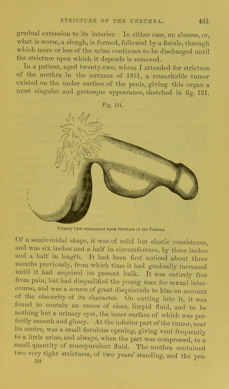 gradual extension to its interior. In either case, an abscess, or, what is worse, a slough, is formed, followed by a fistule, through which more or less of the urine continues to be discharged until the stricture upon which it depends is removed. In a patient, aged twenty-two, whom I attended for stricture of the urethra in the autumn of 1851, a remarkable tumor existed on the under surface of the penis, giving this organ a most singular and grotesque appearance, sketched in fig. 131. Fig. 131. Urinary Cyst consequent upon Stricture of the Urethra. Of a semiovoidal shape, it was of solid but elastic consistence, and was six inches and a half in circumference, by three inches and a half in length. It had been first noticed about three months previously, from which time it had gradually increased until it had acquired its present bulk. It was entirely free from pain, but had disqualified the young man for sexual inter- course, and was a source of great disquietude to him on account of the obscurity of its character. On. cutting into it, it was found to contain an ounce of clear, limpid fluid, and to be nothing but a urinary cyst, the inner surface of which was per- fectly smooth and glossy. At the inferior part of the tumor, nea v its centre, was a small fistulous opening, giving vent frequently to a little urine, and always, when the part was compressed, to a small quantity of mucopurulent fluid. The urethra contained two very tight strictures, of two years' standing, and the pro- 30