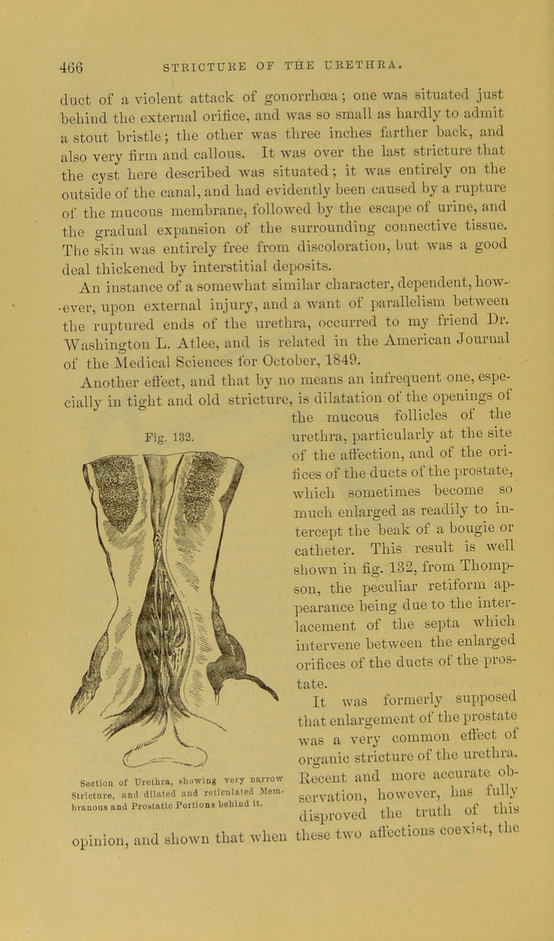 Fig. 132. duct of a violent attack of gonorrhoea; one was situated just behind the external orifice, and was so small as hardly to admit a stout bristle; the other was three inches farther hack, and also very firm and callous. It was over the last stricture that the cyst here described was situated; it was entirely on the outside of the canal, and had evidently been caused by a rupture of the mucous membrane, followed by the escape of urine, and the gradual expansion of the surrounding connective tissue. The skin was entirely free from discoloration, but was a good deal thickened by interstitial deposits. An instance of a somewhat similar character, dependent, how- • ever, upon external injury, and a want of parallelism between the ruptured ends of the urethra, occurred to my friend Dr. Washington L. Atlee, and is related in the American Journal of the Medical Sciences for October, 1849. Another effect, and that by no means an infrequent one, espe- cially in tight and old stricture, is dilatation of the openings of the mucous follicles of the urethra, particularly at the site of the affection, and of the ori- fices of the ducts of the prostate, which sometimes become so much enlarged as readily to in- tercept the beak of a bougie or catheter. This result is well shown in fig. 132, from Thomp- son, the peculiar retiform ap- pearance being due to the inter- lacement of the septa which intervene between the enlarged orifices of the ducts of the pros- tate. It was formerly supposed that enlargement of the prosta f e was a very common effect of organic stricture of the urethra. Recent and more accurate ob- servation, however, has fully disproved the truth of this opinion, and shown that when these two affections coexist, the Section of Urethra, showing very narrow Stricture, and dilated and reticulated Mem- branous and Prostatic Portions hehiod it.