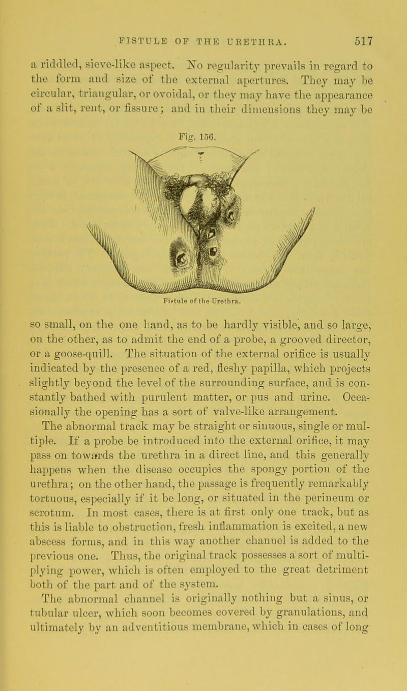 a riddled, Bieve-like aspect. ISTo regularity prevails in regard to the form and size of the external apertures. They may be circular, triangular, or ovoidal, or they may have the appearance of a slit, rent, or fissure; and in their dimensions they may he Fig. 15G. Fistule of the Urethra. so small, on the one hand, as to be hardly visible, and so large, on the other, as to admit the end of a probe, a grooved director, or a goose-quill. The situation of the external orifice is usually indicated by the presence of a reel, fleshy papilla, which projects slightly beyond the level of the surrounding surface, and is con- stantly bathed with purulent matter, or pus and urine. Occa- sionally the opening has a sort of valve-like arrangement. The abnormal track may be straight or sinuous, single or mul- tiple. If a probe be introduced into the external orifice, it may pass on towards the urethra in a direct line, and this generally happens when the disease occupies the spongy portion of the urethra; on the other hand, the passage is frequently remarkably tortuous, especially if it be long, or situated in the perineum or scrotum. In most cases, there is at first only one track, but as this is liable to obstruction, fresh inflammation is excited, a new abscess forms, and in this way another channel is added to the previous one. Thus, the original track possesses a sort of multi- plying power, which is often employed to the great detriment both of the part and of the system. The abnormal channel is originally nothing but a sinus, or tubular nicer, which soon becomes covered by granulations, and ultimately by an adventitious membrane, which in cases of long