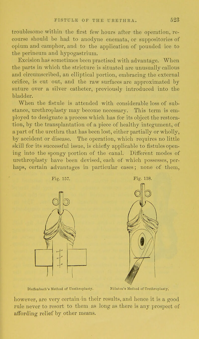 troublesome within the first few hours after the operation, re- course should he hud to anodyne enemata, or suppositories of opium and camphor, and to the application of pounded ice to the perineum and hypogastrium. Excision has sometimes been practised with advantage. When the parts in which the stricture is situated are unusually callous and circumscribed, an elliptical portion, embracing the external orifice, is cut out, and the raw surfaces are approximated by suture over a silver catheter, previously introduced into the bladder. When the fistule is attended with considerable loss of sub- stance, urethroplasty may become necessary. This term is em- ployed to designate a process which has for its object the restora- tion, by the transplantation of a piece of healthy integument, of apart of the urethra that has been lost, either partially or wholly, by accident or disease. The operation, which requires no little skill for its successful issue, is chiefly applicable to fistules open- ing into the spongy portion of the canal. Different modes of urethroplasty have been devised, each of which possesses, per- haps, certain advantages in particular cases; none of them, Fig. 157. Fig. 158. Dieffenbach's Method of Urethroplasty. Nelaton's Method of Urethroplasty, however, are very certain-in their results, and hence it is a good rule never to resort to them as long as there is any prospect of affording relief by other means.