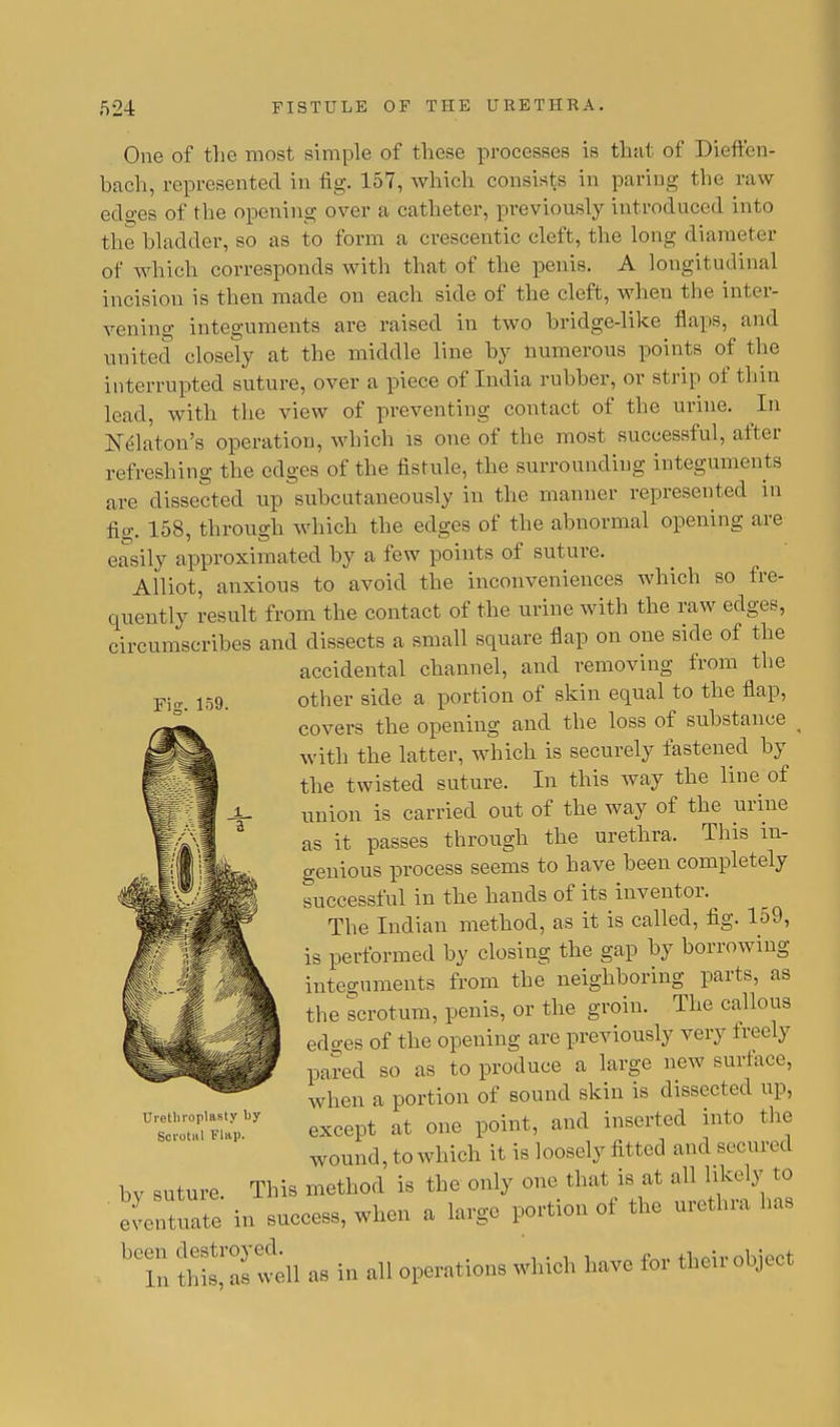 One of the most simple of these processes is that of Dieften- bach, represented in fig. 157, which consists in paring the raw edges of the opening over a catheter, previously introduced into the bladder, so as to form a crescentic cleft, the long diameter of which corresponds with that of the penis. A longitudinal incision is then made on each side of the cleft, when the inter- vening integuments are raised in two bridge-like flaps, and united closely at the middle line by numerous points of the interrupted suture, over a piece of India rubber, or strip of thin lead, with the view of preventing contact of the urine. In JSTelaton's operation, which is one of the most successful, after refreshing the edges of the fistule, the surrounding integuments are dissected up subciitaneously in the manner represented in fig. 158, through which the edges of the abnormal opening are easily approximated by a few points of suture. Alliot, anxious to avoid the inconveniences which so fre- quently result from the contact of the urine with the raw edges, circumscribes and dissects a small square flap on one side of the accidental channel, and removing from the other side a portion of skin equal to the flap, covers the opening and the loss of substance i with the latter, which is securely fastened by the twisted suture. In this way the line of union is carried out of the way of the urine as it passes through the urethra. This in- genious process seems to have been completely successful in the hands of its inventor. The Indian method, as it is called, fig. lo9, is performed by closing the gap by borrowing integuments from the neighboring parts, as the scrotum, penis, or the groin. The callous edges of the opening are previously very freely pared so as to produce a large new surface, when a portion of sound skin is dissected up, except at one point, and inserted into the wound, to which it is loosely fitted and secured bv suture This method is the only one that is at all likely to eventual in success, when a large portion of the urethra has bCln thtastll as in all operations which have for their object Urethroplasty by Scrotal Flap.