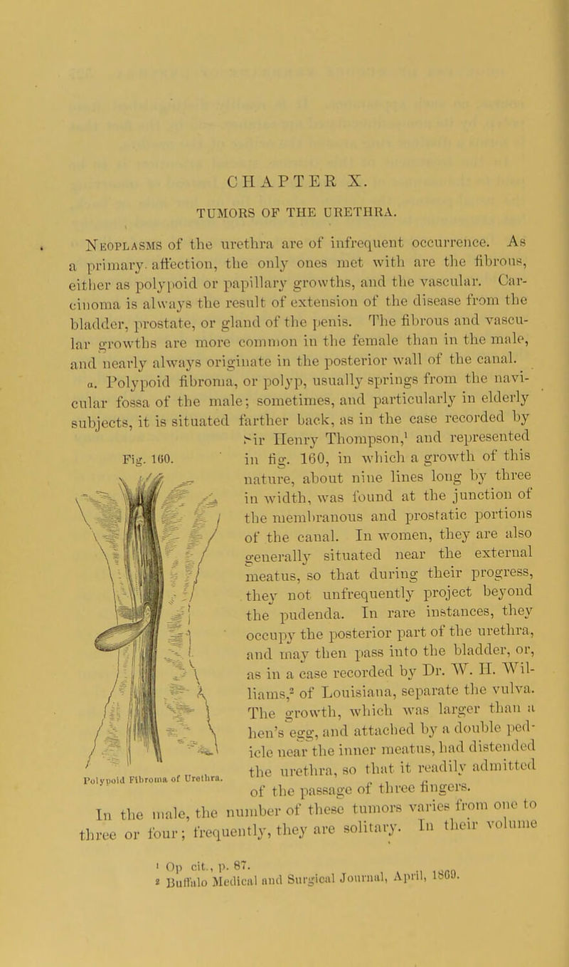 TUMORS OF THE URETHRA. Neoplasms of the urethra are of infrequent occurrence. As a primary, affection, the only ones met with are the fibrous, either as polypoid or papillary growths, and the vascular. Car- cinoma is always the result of extension of the disease from the bladder, prostate, or gland of the penis. The fibrous and vascu- lar growths are more common in the female than in the male, and nearly always originate in the posterior wall of the canal. a. Polypoid fibroma, or polyp, usually springs from the navi- cular fossa of the male; sometimes, and particularly in elderly subjects, it is situated farther back, as in the case recorded by Sir Henry Thompson,1 and represented in fig. 160, in which a growth of this nature, about nine lines long by three in width, was found at the junction of the membranous and prostatic portions of the canal. In women, they are also generally situated near the external meatus, so that during their progress, they not unfrequently project beyond the pudenda. In rare instances, they occupy the posterior part of the urethra, and may then pass into the bladder, or, as in a case recorded by Dr. W. H. A\ d- liams,2 of Louisiana, separate the vulva. The growth, which was larger than a hen's egg, and attached by a double ped- icle near the inner meatus, had distended the urethra, so that it readily admitted of the passage of three fingers. In the male, the number of these tumors varies from one to three or four; frequently, they are solitary. In their volume Polypoid Fibroma of Urethra. ' ()|i cit., p. 87. i Buffalo Medical and Surgical Journal, April, I860.