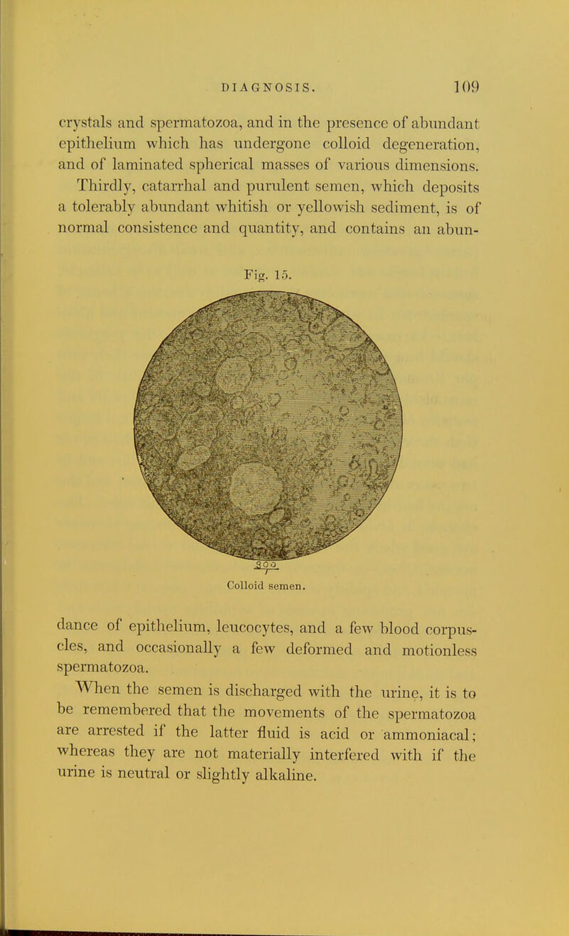 crystals and spermatozoa, and in the presence of abnndant epithelium which has undergone colloid degeneration, and of laminated spherical masses of various dimensions. Thirdly, catarrhal and purulent semen, which deposits a tolerably abundant whitish or yellowish sediment, is of normal consistence and quantity, and contains an abun- Fig. 15. Colloid semen. dance of epithelium, leucocytes, and a few blood corpus- cles, and occasionally a few deformed and motionless spermatozoa. When the semen is discharged with the urine, it is to be remembered that the movements of the spermatozoa are arrested if the latter fluid is acid or ammoniacal; whereas they are not materially interfered with if the urine is neutral or slightly alkaline.