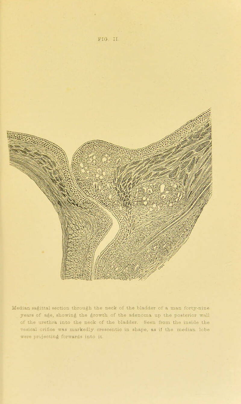 Median sagittal section through the neck of the bladder oi' a man i'orty-nine years of age, showing the growth of the adenoma up the posterior w:iU of the urethra into the neck of the bladder. Seen i'rom the inside the vesical orifice was markedly cresceutic in shape, as if the median lobe were projecting forwards into it