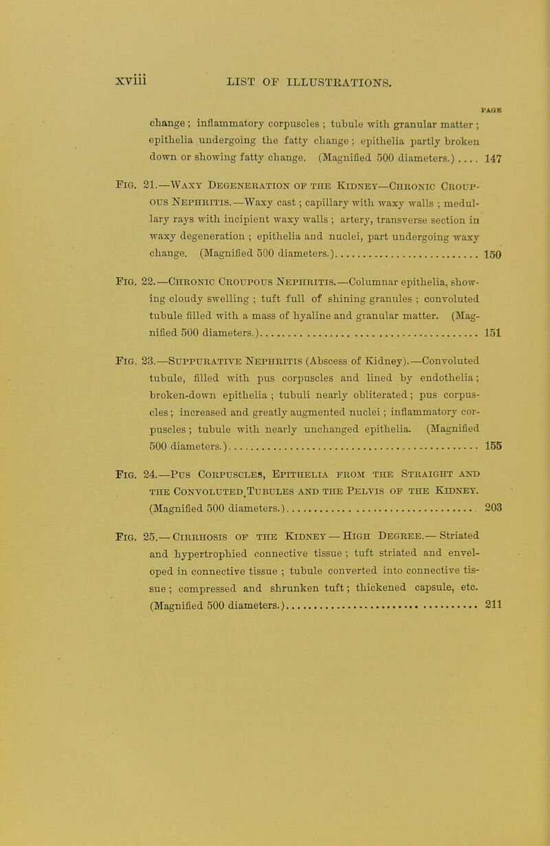 PAOR change ; inflammatory corpuscles ; tubule with granular matter ; epithelia undergoing the fatty change ; epithelia partly broken down or showing fatty change. (Magnified 500 diameters.) 147 Pig. 21.—Waxy Degeneration of the Kidney—Chronic Croup- ous Nephritis.—Waxy cast; capillary with waxy walls ; medul- lary rays with incipient waxy walls ; artery, transverse section in waxy degeneration ; epithelia and nuclei, part undergoing waxy change. (Magnified 500 diameters.) 150 Fig, 22.—Chronic Croupous Nephritis.—Columnar epithelia, show- ing cloudy swelling ; tuft full of shining graniiles ; convoluted tubule filled with a mass of hyaline and granular matter. (Mag- nified 500 diameters.) 151 Fig. 33.—Suppurative Nephritis (Abscess of Kidney).—Convoluted tubule, filled with pus corpuscles and lined by endothelia; broken-down epithelia ; tubuli nearly obliterated; pus corpus- cles ; increased and greatly augmented nuclei; inflammatory cor- puscles ; tubule with nearly unchanged epithelia. (Magnified 500 diameters.) 155 Fig. 24.—Pus Corpuscles, Epithelia from the Straight and THE C0NV0LUTED_TUBULES AND THE PeLVIS OF THE KlDNEY. (Magnified 500 diameters.) 203 Fig. 25.— Cirrhosis op the Kidney — High Degree.— Striated and hypertrophied connective tissue ; tuft striated and envel- oped in connective tissue ; tubule converted into connective tis- sue ; compressed and shrunken tuft; thickened capsule, etc. (Magnified 500 diameters.) 211