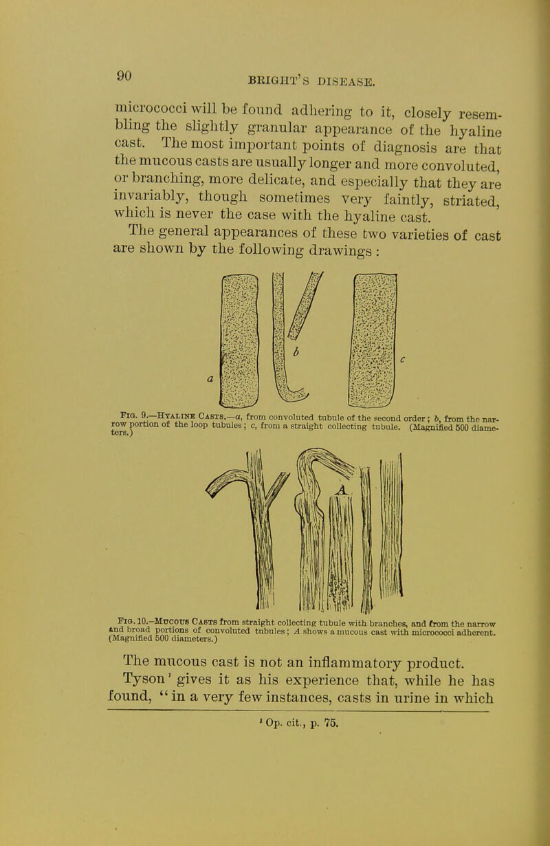 micrococci will be found adliering to it, closely resem- bling the slightly granular appearance of the hyaline cast. The most important points of diagnosis are that the mucous casts are usually longer and more convoluted, or branching, more delicate, and especially that they are invariably, though sometimes very faintly, striated, which is never the case with the hyaline cast. The general appearances of these two varieties of cast are shown by the following drawings : .if. Fig. 9.—Hyaline Casts.—a, from convoluted tubule of the second order; 6 from the nar- row portion of the loop tubules; c, from a straight collecting tubule. (Magnified 500 diame- ^^t' ^•-MuootTS Oasts from straight collecting tubule with branches, and from the narrow end broad portions of convoluted tubules; A shows a mucous cast with micrococci adherent. (Magnified 500 diameters.) The mucous cast is not an inflammatory product. Tyson' gives it as his experience that, while he has found,  in a very few instances, casts in urine in which ' Op. cit., p. 75.