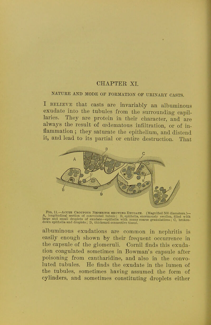 NATURE AND MODE OF FORMATION OP URINARY CASTS, I BELIEVE that casts are invariably an albuminous exudate into tlie tubules from the surrounding capil- laries. They are protein in their character, and are always the result of oedematous infiltration, or of in- flammation ; they saturate the epithelium, and distend it, and lead to its partial or entire destruction. That Fig. 11.—Acute CROUPOns Nephritis showing Exudate. (Magnified 500 diameters.)— A, longitudinal section of convoluted tubule; B, epithelia, enormously swollen, filled with large and small droplets of exudate—epithelia with, many coarse granulations; C, broken- down epithelia and droplets ; D, thickened connective tissue. albuminous exudations are common in nephritis is easily enough shown by their frequent occurrence in the capsule of the glomeruli. Cornil finds this exuda- tion coagulated sometimes in Bowman's capsule after poisoning from cantharidine, and also in the convo- luted tubules. He finds the exudate in the lumen of the tubules, sometimes having assumed the form of cylinders, and sometimes constituting droplets either