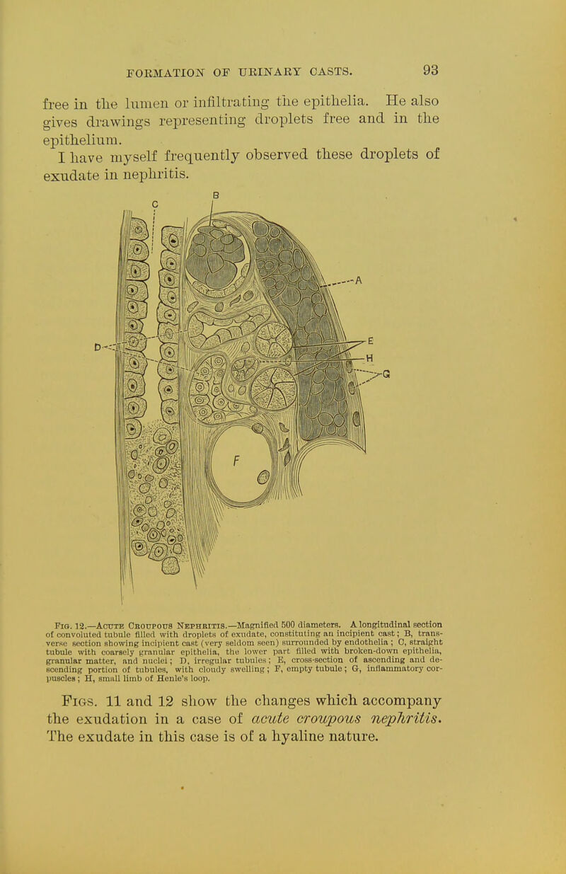 free in tlie lumen or infiltrating the epitlielia. He also gives drawings representing droplets free and in tlie epithelium. I have myself frequently observed these droplets of exudate in nephritis. B Fig. 12.—^Actjte Crotjpotjs Nephritis.—Magnified BOO diameters. A longitudinal section ol convoluted tubule filled with droplets of exudate, constituting an incipient cast; B, trans- verse section showing incipient cast (very seldom seen) surrounded by endothelia ; 0, straight tubule with coarsely granular epithelia, the lower part filled with broken-down epithelia, gianular matter, and nuclei; D. irregular tubules; E, cross-section of ascending and de- scending portion of tubules, with cloudy swelling; F, empty tubule; a, inflammatory cor- puscles ; H, small limb of Henle's loop. Figs. 11 and 12 show the changes which accompany the exudation in a case of acute croupous nephritis. The exudate in this case is of a hyaline nature.