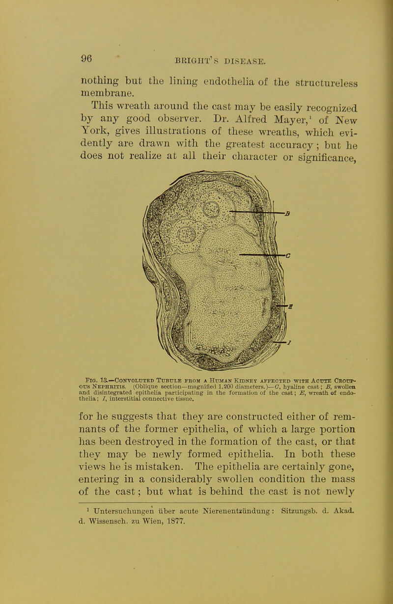 nothing but tlie lining eiidotlielia of the structureless membrane. This wreath around the cast may be easily recognized by any good observer. Dr. Alfred Mayer,' of IS^ew York, gives illustrations of these wreaths, which evi- dently are drawn with the greatest accuracy; but he does not realize at all their character or significance, Fig. 13.—CoNVOLtTTBD Tubule prom a Human Kidney atfeoted with Aoute Cboup- ous Nephritis. (Oblique section—magnified 1.200 diameters.)—C, hyaline cast; B, swollen and disintegrated epithelia participating in the formation of the cast; E, wreath of endo- thelia; /, interstitial connective tissue. for he suggests that they are constructed either of rem- nants of the former epithelia, of which a large portion has been destroyed in the formation of the cast, or that they may be newly formed epithelia. In both these views he is mistaken. The epithelia are certainly gone, entering in a considerably swollen condition the mass of the cast; but what is behind the cast is not newly * Untersucliungen iiber acute Nierenentziindung: Sitzungsb. d. Akad. d. Wissensch. zii Wien, 1877.