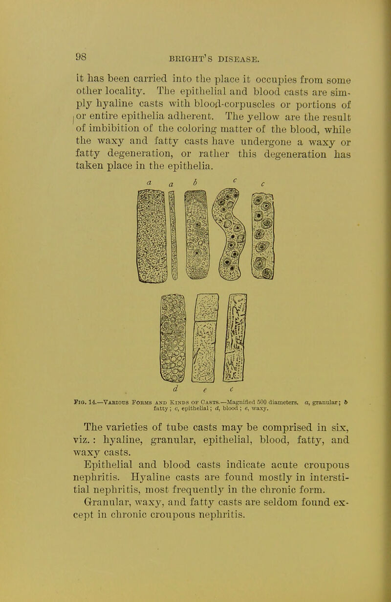 It has been carried into the place it occupies from some other locality. The epithelial and blood casts are sim- ply hyaline casts with blood-corpuscles or portions of (Or entire epithelia adherent. The yellow are the result of imbibition of the coloring matter of the blood, while the waxy and fatty casts have undergone a waxy or fatty degeneration, or rather this degeneration has taken place in the epithelia. a a b c d e <^ FlO. 14.—Vabious Fobms and Kinds of Casts.—Magnified 500 diameters, a, granular; ^ fatty ; c, epithelial; d, blood ; e, waxy. The varieties of tube casts may be comprised in six, viz. : hyaline, granular, epithelial, blood, fatty, and waxy casts. Epithelial and blood casts indicate acute croupous nephritis. Hyaline casts are found mostly in intersti- tial nephritis, most frequently'' in the chronic form. Granular, waxy, and fatty casts are seldom found ex- cept in chronic croupous nephritis.
